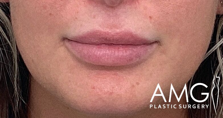Close-up of a person's lips with "AMG Plastic Surgery" text in the corner.