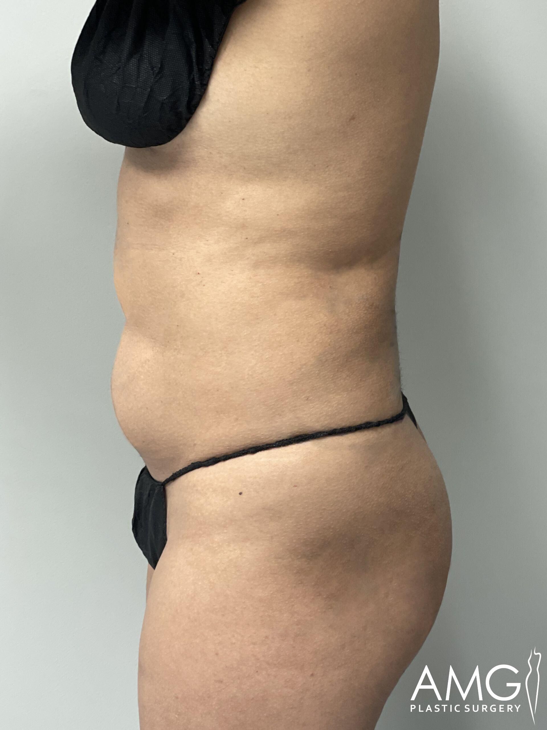Side profile of a person's torso and upper legs in black undergarments, marked with a line across the lower abdomen. Logo in the bottom right corner reads "AMG Plastic Surgery.