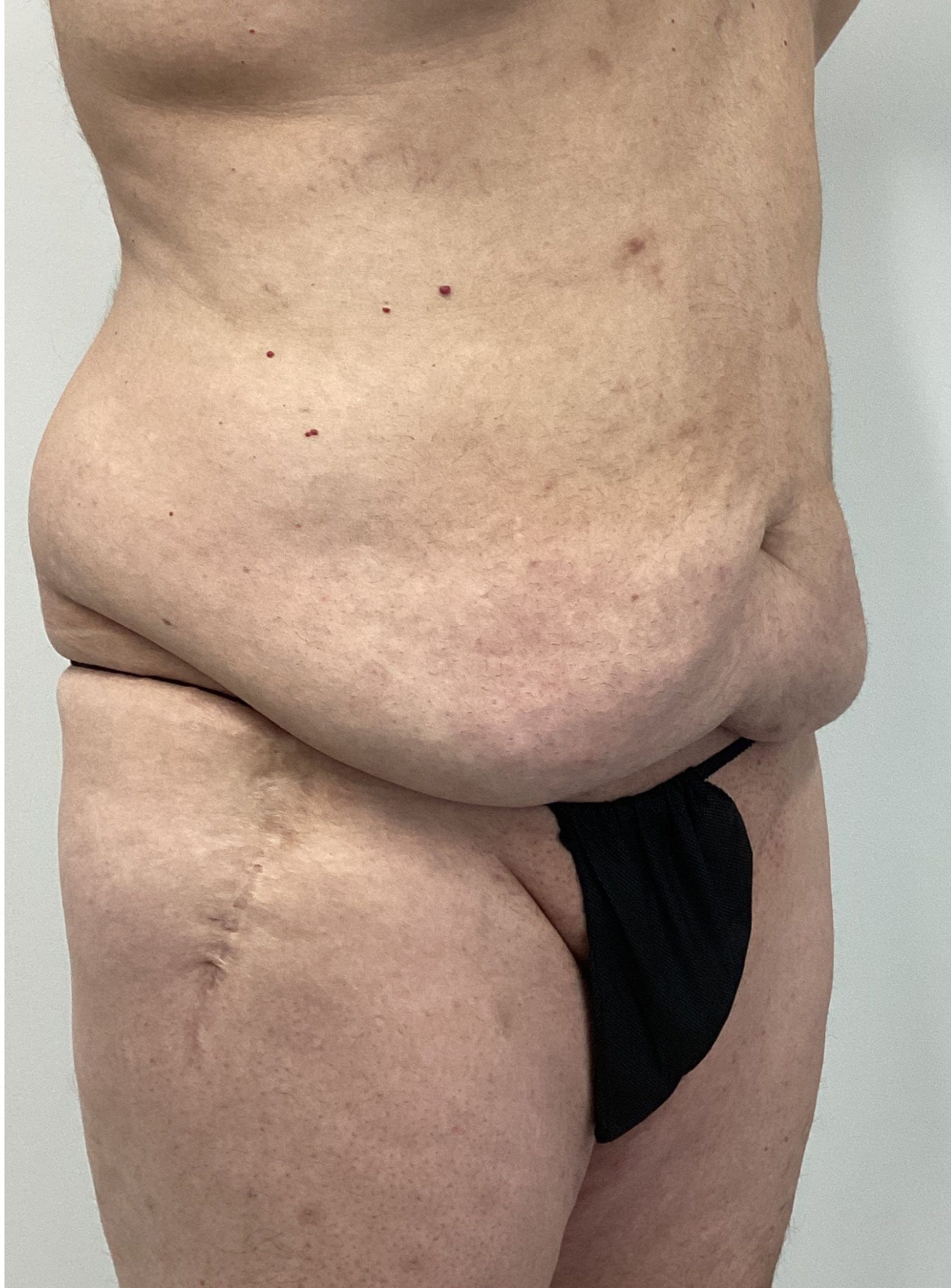 Profile view of a person's torso, showing abdomen and hips with visible scarring and loose skin. Wearing a black undergarment. Logo of a plastic surgery clinic is visible in the corner.
