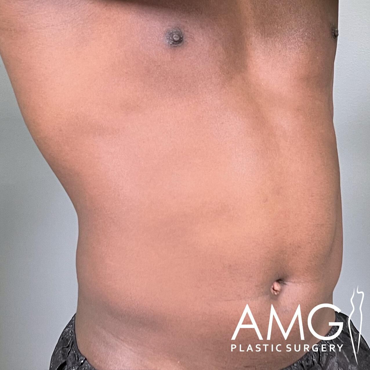 Close-up of a person's abdomen with the logo "AMG Plastic Surgery" in the bottom right corner.