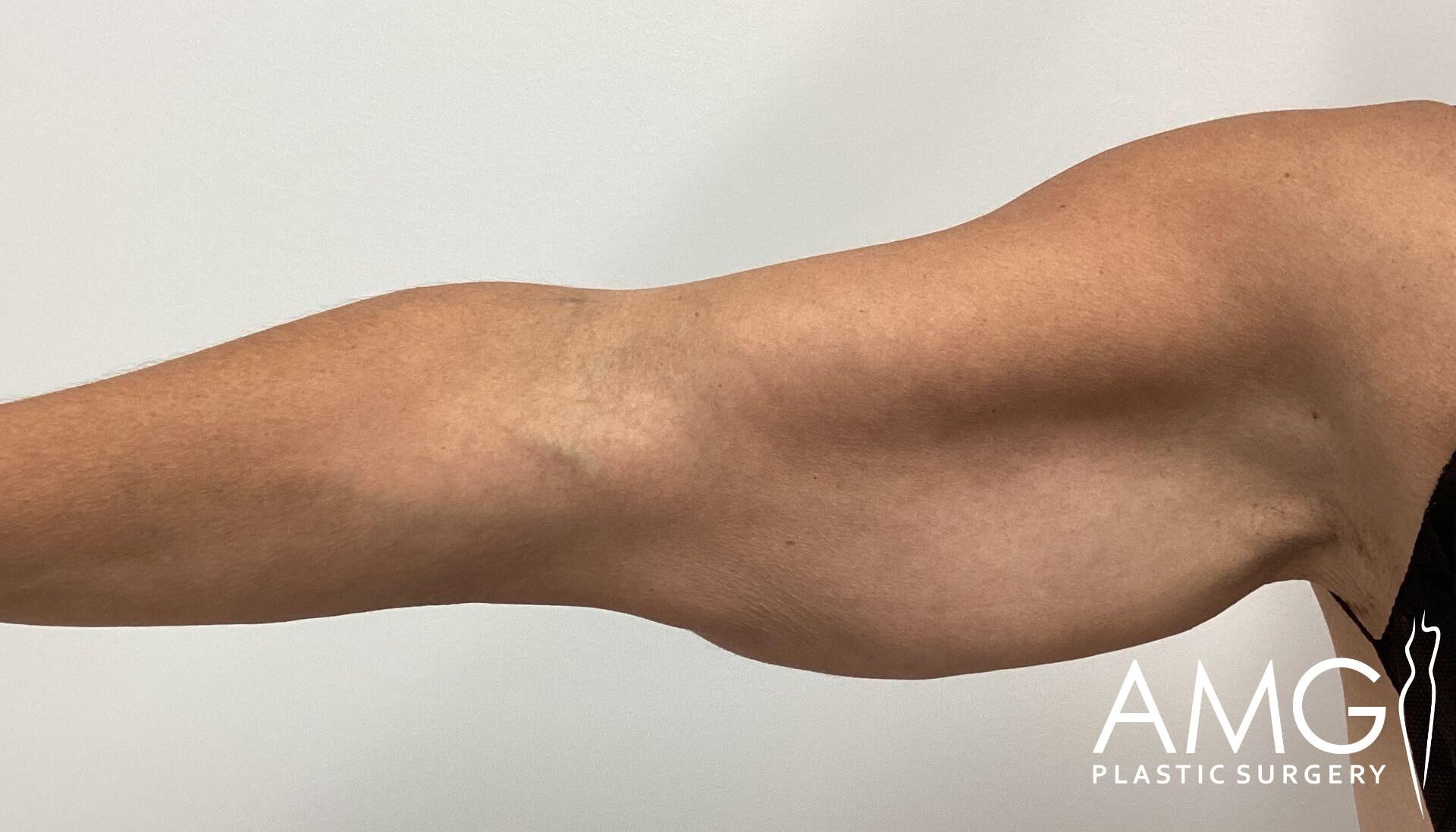 A close-up of an extended muscular arm with defined triceps, against a plain white background.