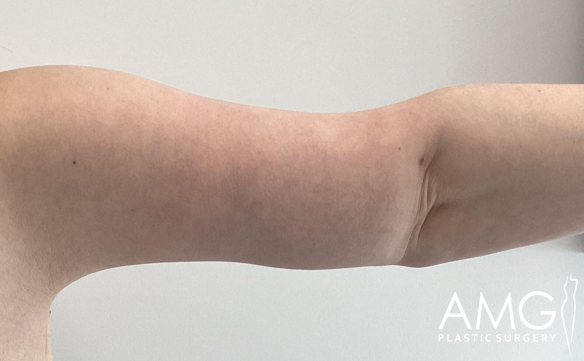 Close-up of a person's upper arm with loose skin, showing signs of natural sagging. The image has a watermark reading "AMG Plastic Surgery" in the bottom right corner.