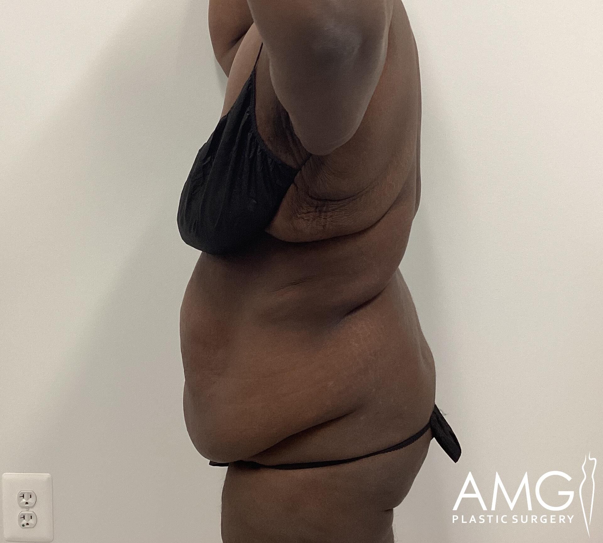 Person in black clothing showing side profile with visible abdominal area. White wall in the background with an electrical outlet. Logo of AMG Plastic Surgery in the bottom right corner.