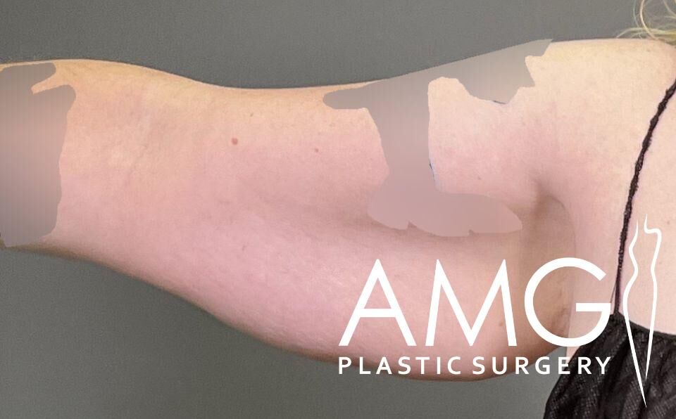 A person's upper arm with noticeable skin irregularities. The image features the AMG Plastic Surgery logo.