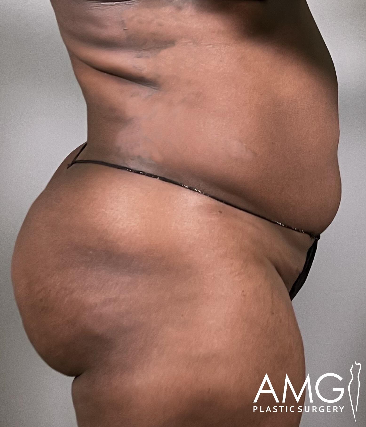 Side view of a person in underwear showing body contours and skin texture. The image includes the logo for AMG Plastic Surgery.