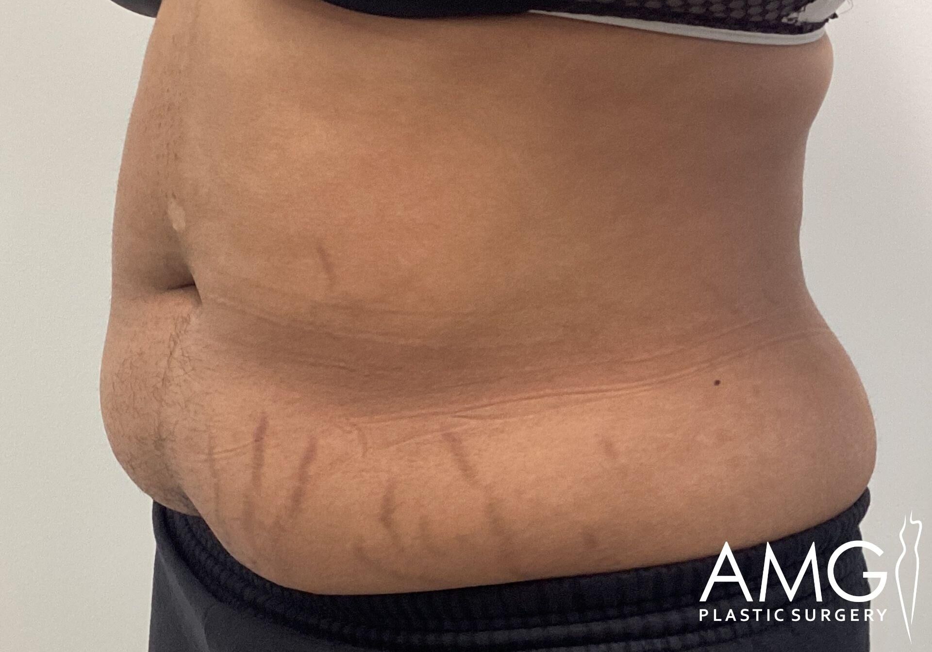 Side view of a person's torso showing stretch marks and excess skin. The individual is wearing black shorts. Logo in the bottom right reads "AMG Plastic Surgery.