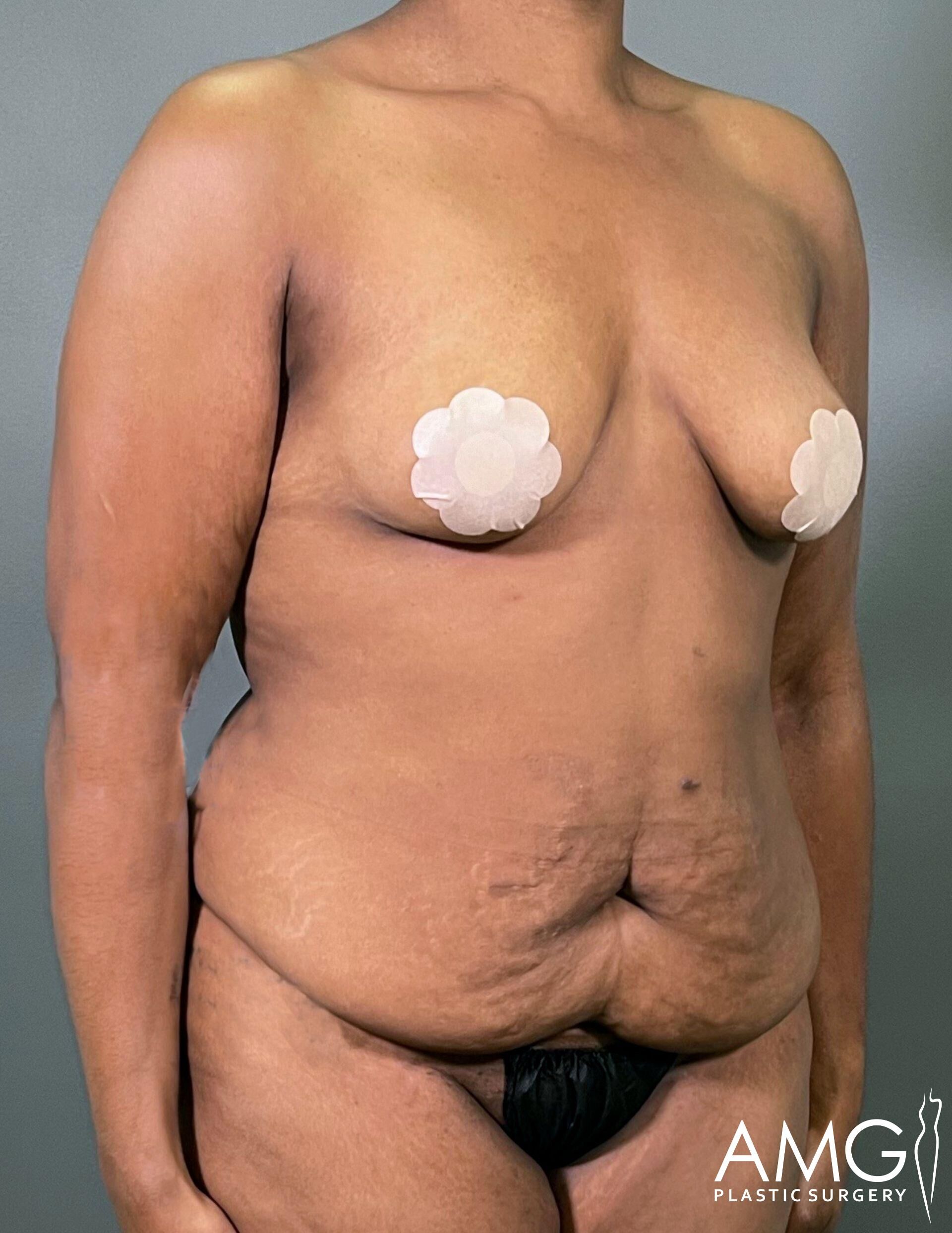A person stands against a plain backdrop, showing the upper body and torso. Nipples are covered with large, flower-shaped pasties. The image has a watermark reading "AMG Plastic Surgery.