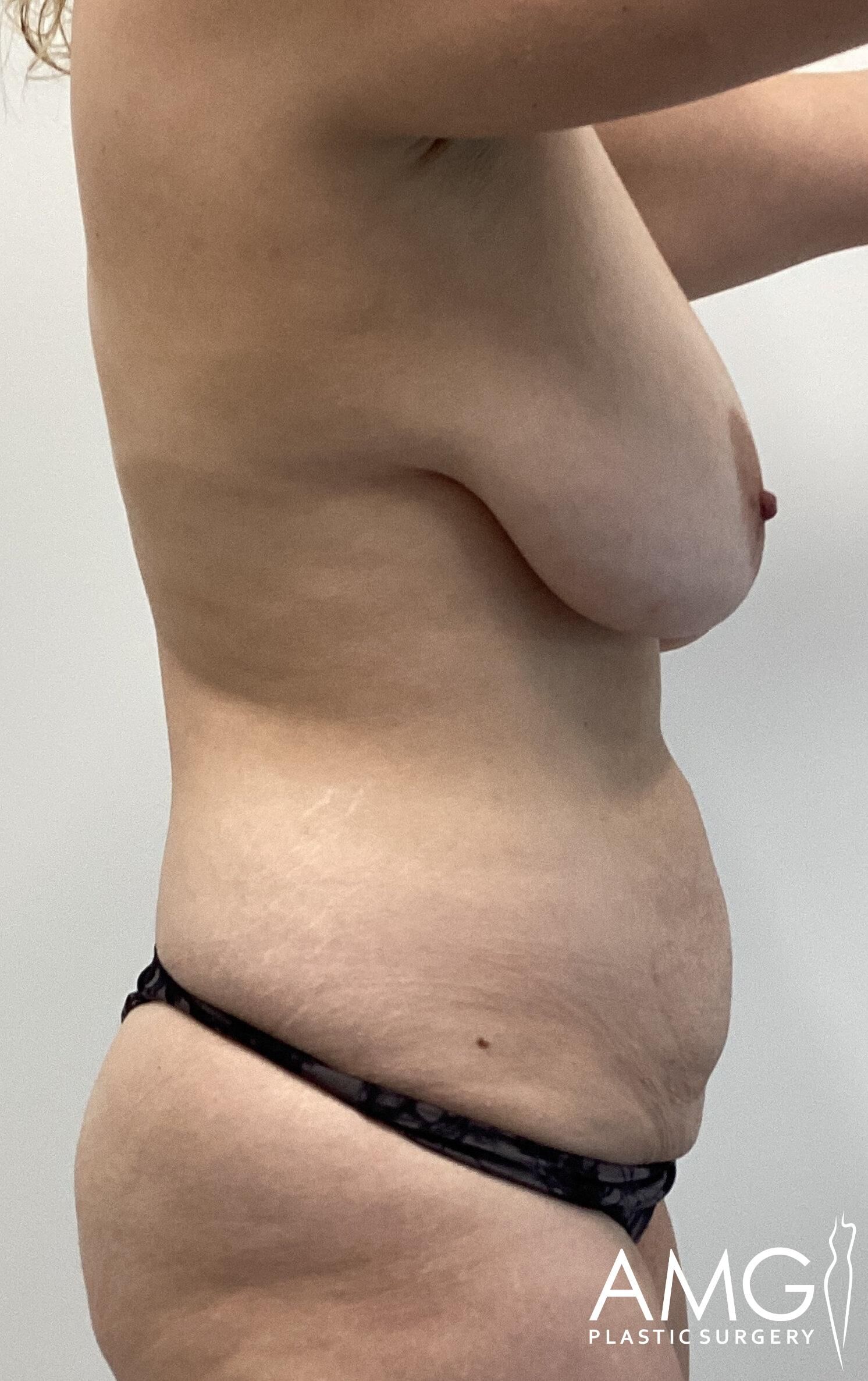 Side profile of a person with bare upper body and black underwear, focusing on the torso. Logo at bottom right reads "AMG Plastic Surgery.