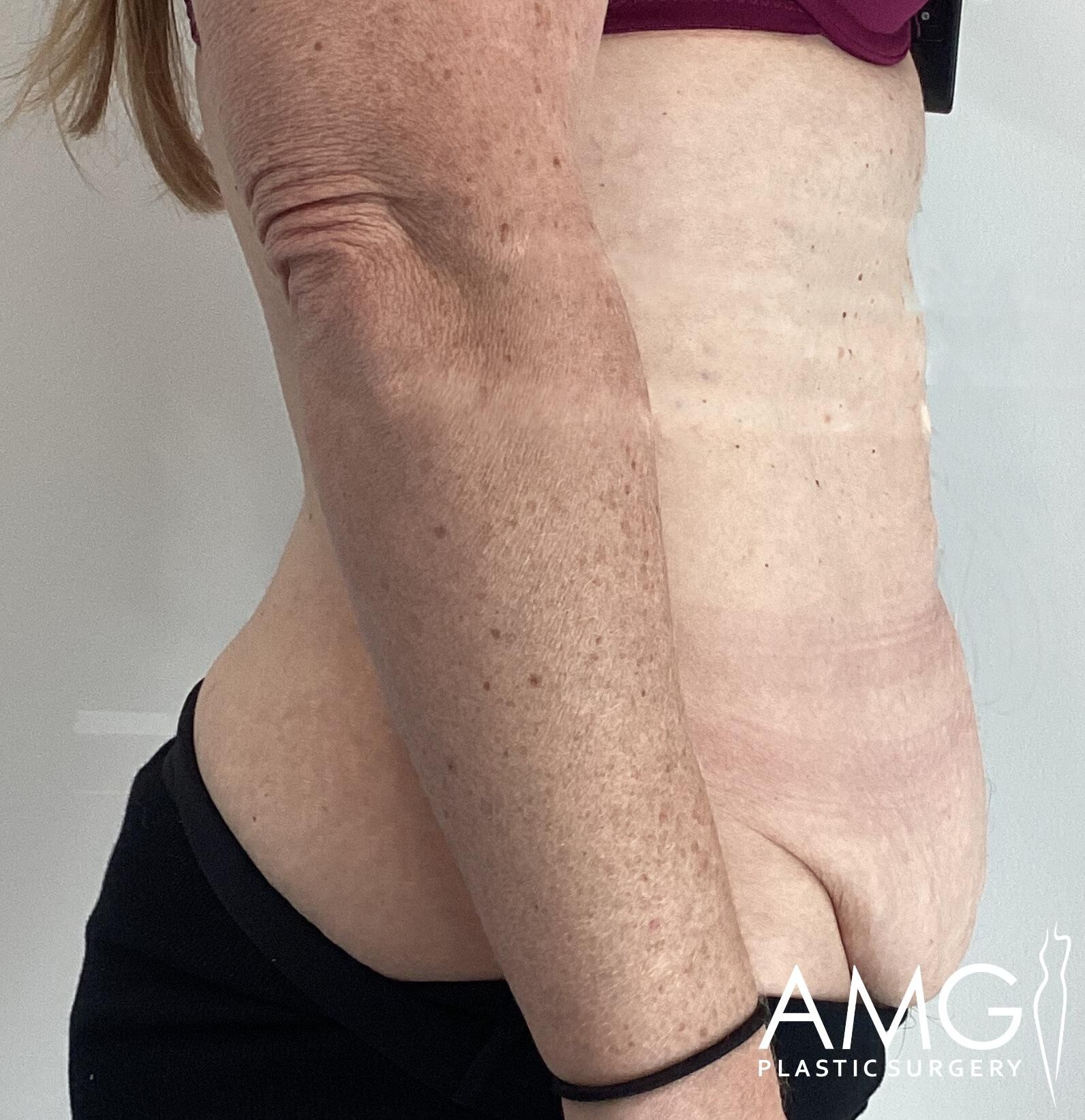 Side view of a person's abdomen and arm showing stretch marks and skin texture. AMG Plastic Surgery logo in the corner.