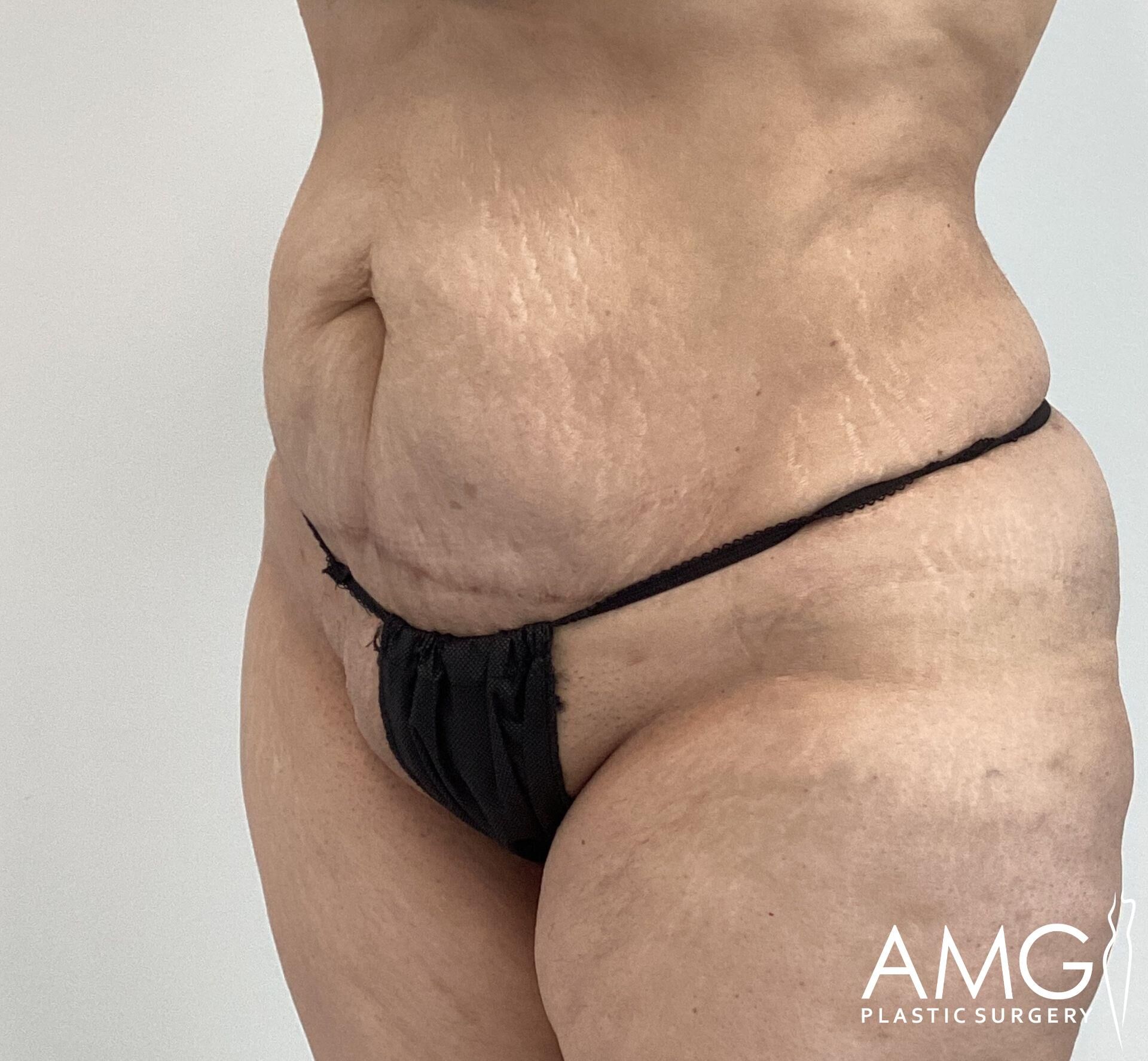 A person wearing black underwear shows the side and front view of their midsection, featuring loose skin and slight scarring. The image is labeled "AMG Plastic Surgery.