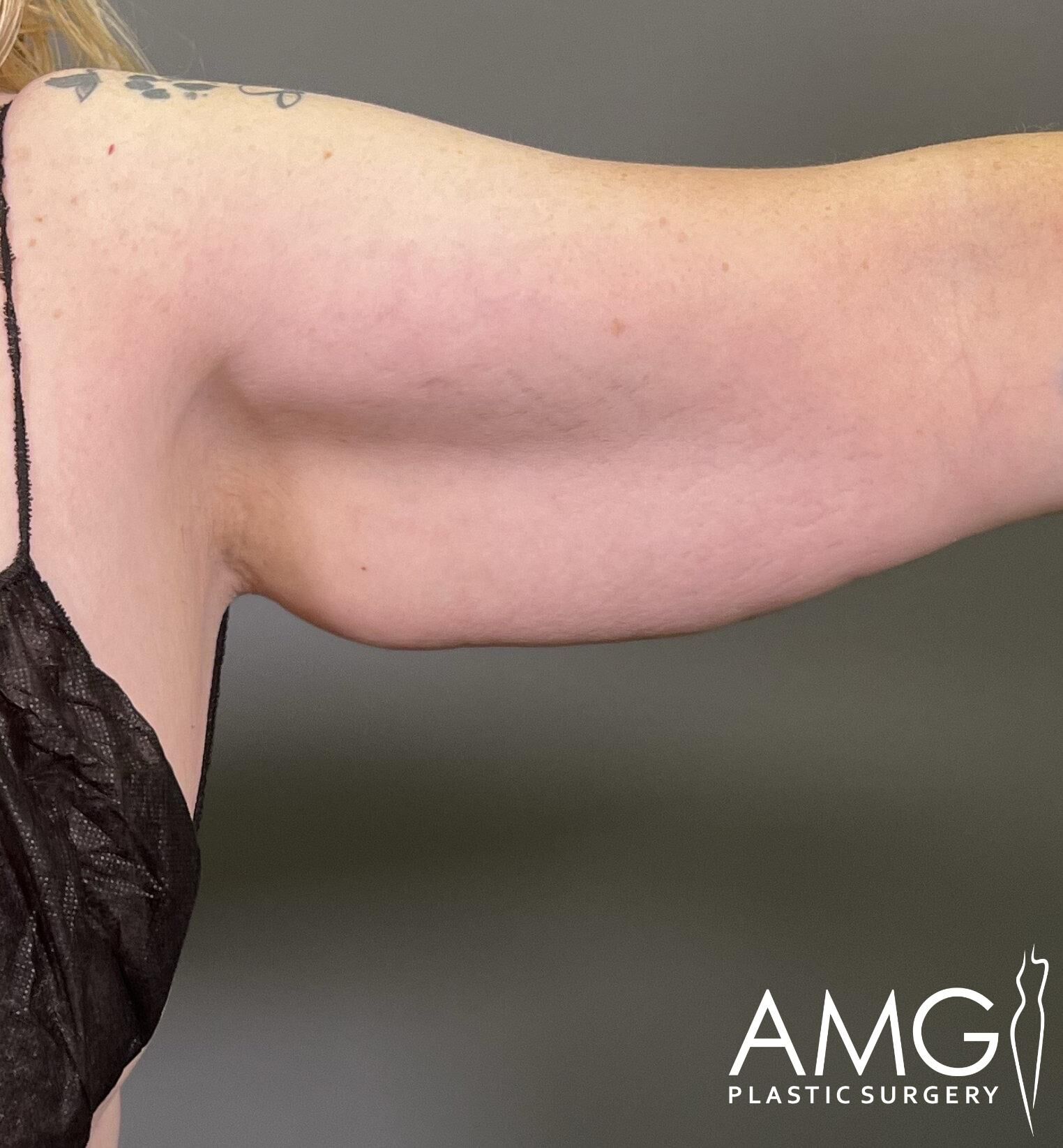 Close-up of a person's upper arm and shoulder with visible skin texture, in a black sleeveless top. "AMG Plastic Surgery" logo is in the bottom right corner.