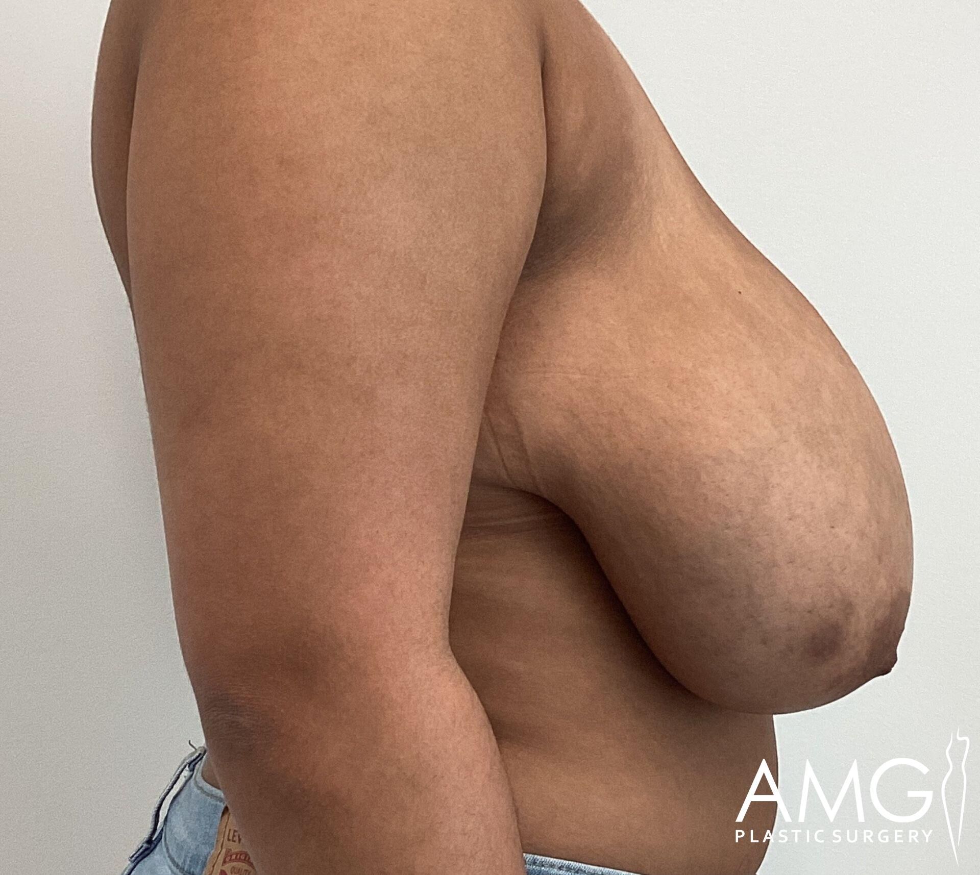 Side view of a person's bare upper body showing asymmetrical breasts. The person is wearing jeans.