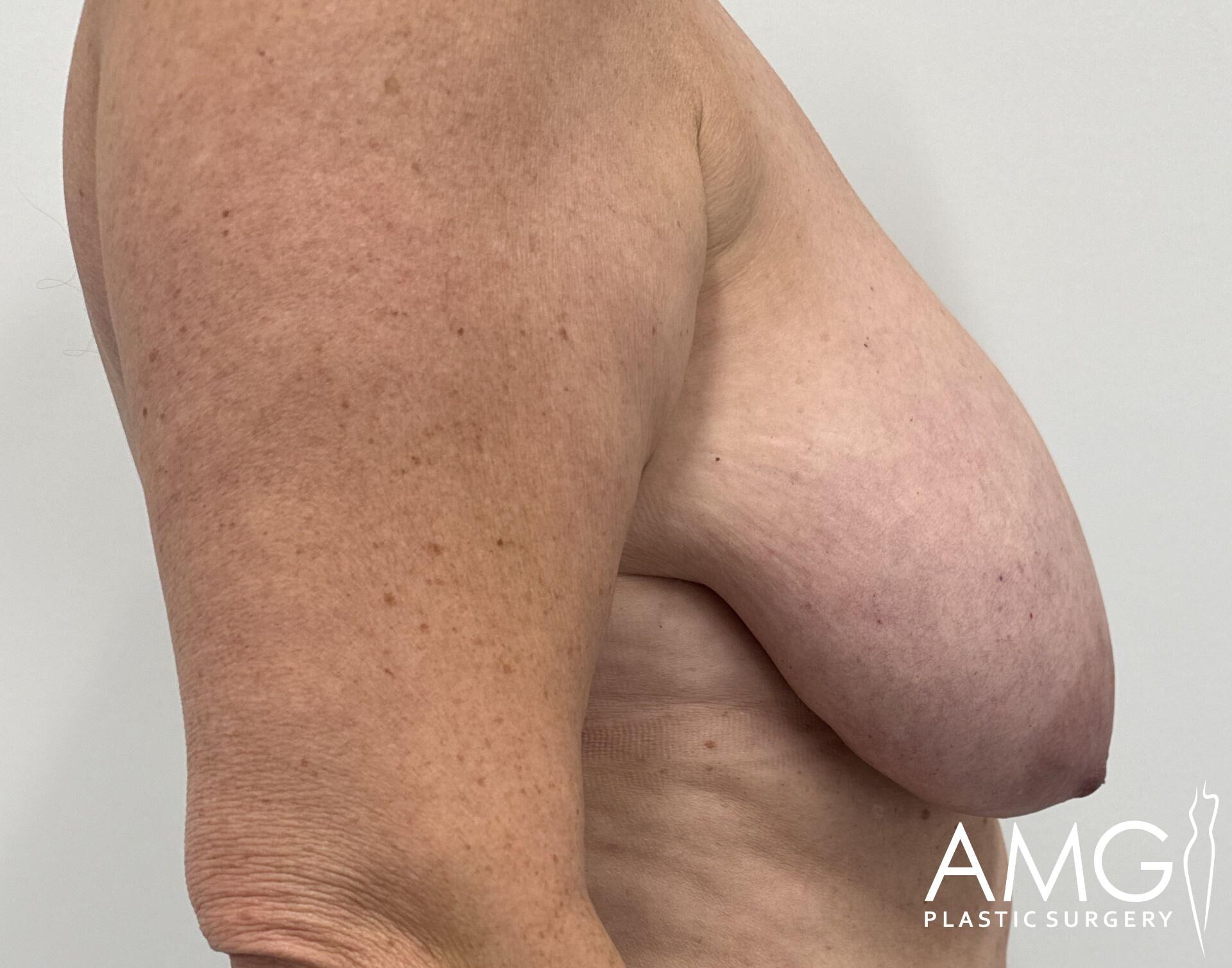 Side view of a person's bare upper body with visible breast sagging. Logo "AMG Plastic Surgery" is in the bottom right corner.
