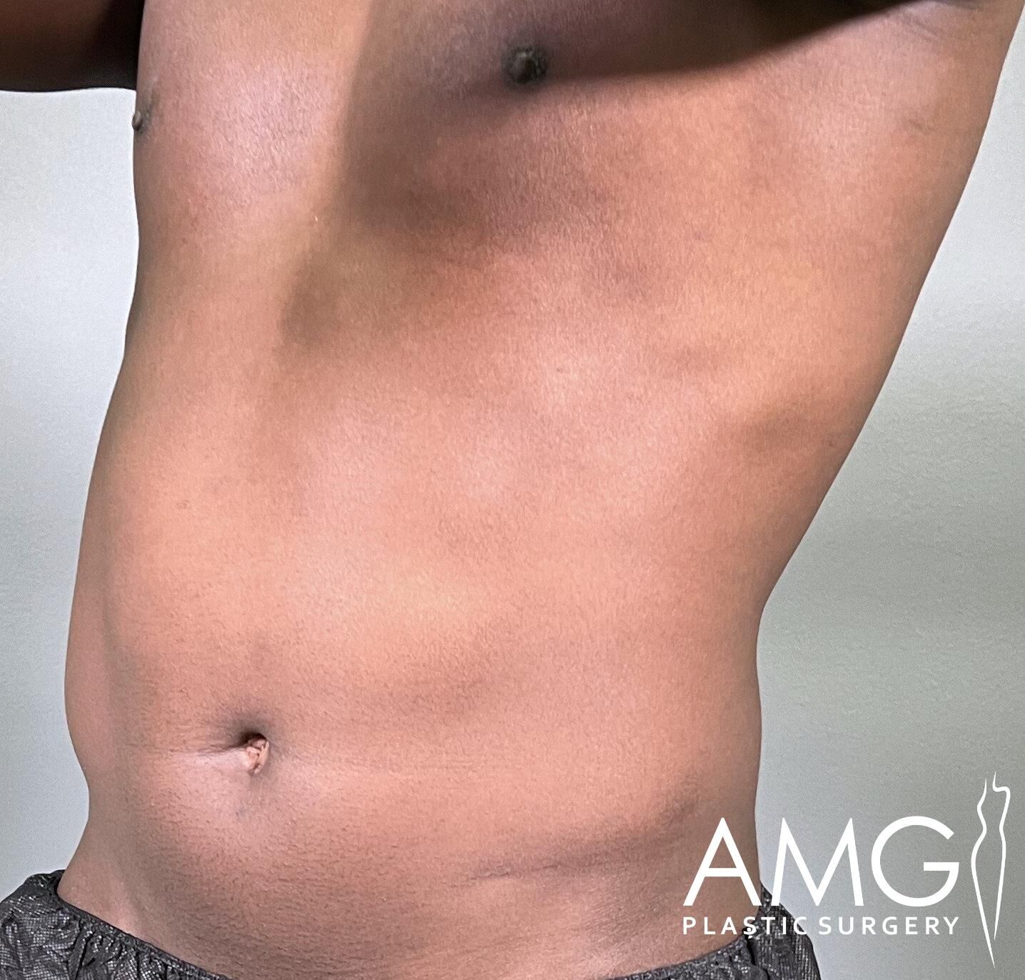 Close-up of a person's bare torso with a neutral expression, showing the abdomen area. The words "AMG Plastic Surgery" are in the bottom right corner.