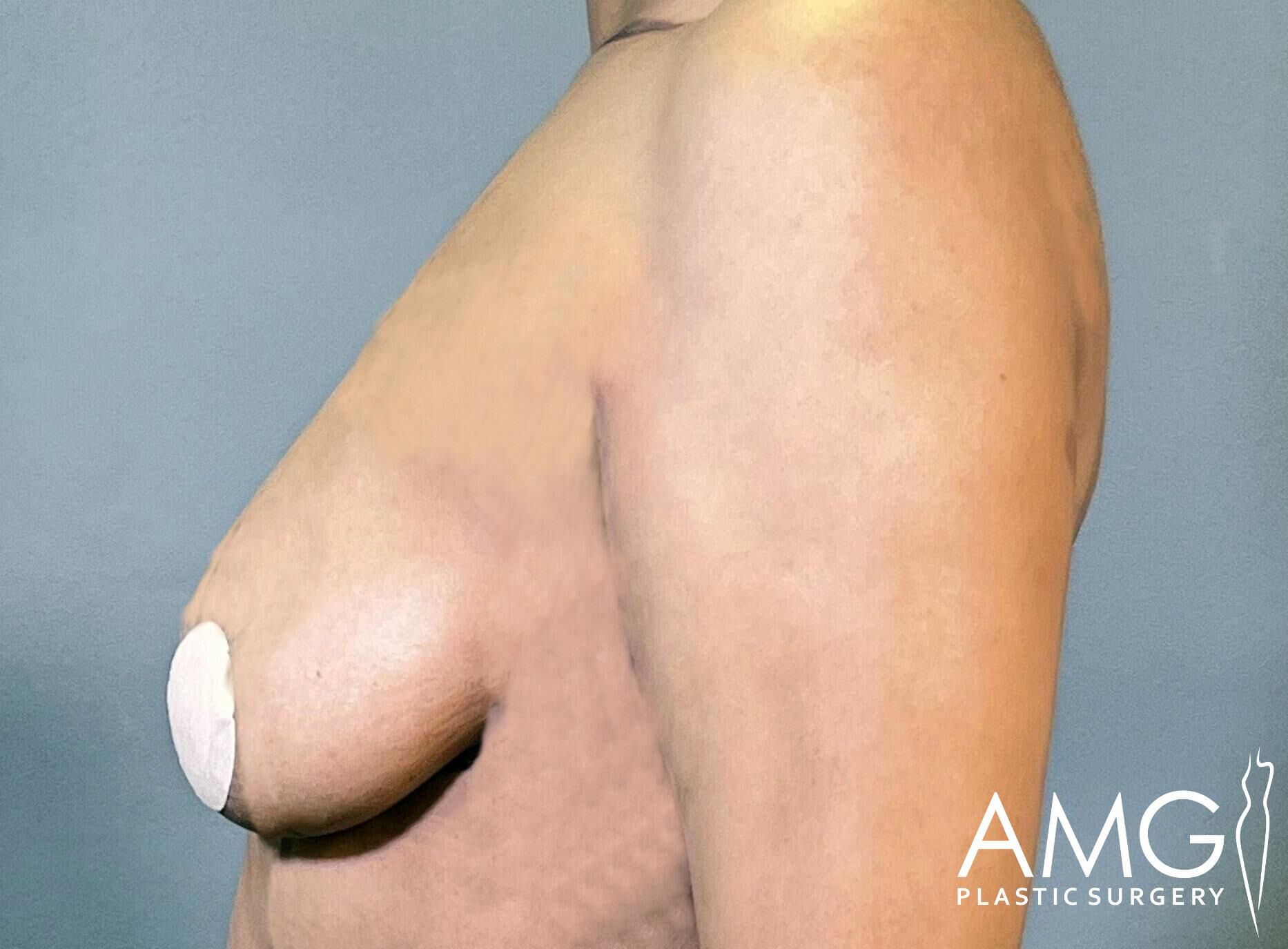 Side profile of a person's upper body with a small bandage on the nipple, against a gray background. AMG Plastic Surgery logo is visible in the bottom right corner.