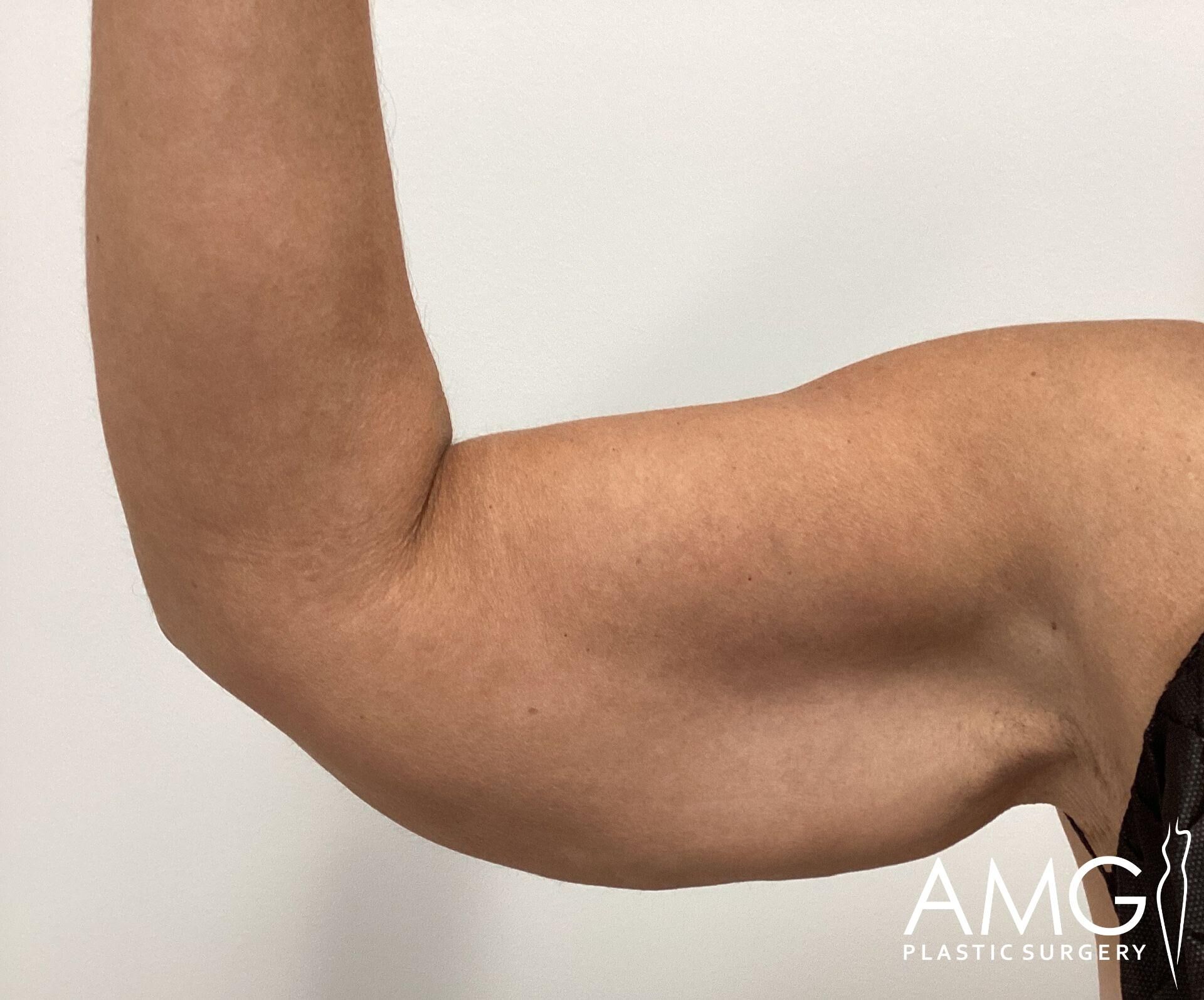 A person flexing their right arm, showing muscle definition.