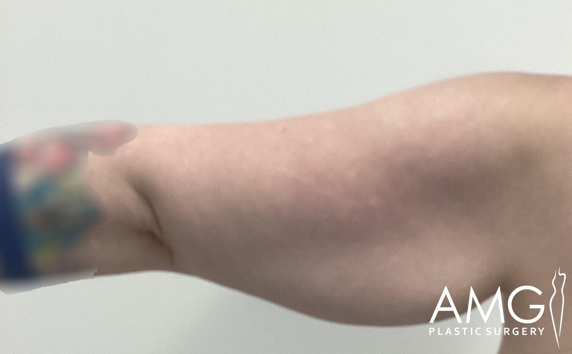 A close-up of a person's upper arm showing loose skin, with a blurred face and hand. The AMG Plastic Surgery logo is visible in the bottom right corner.