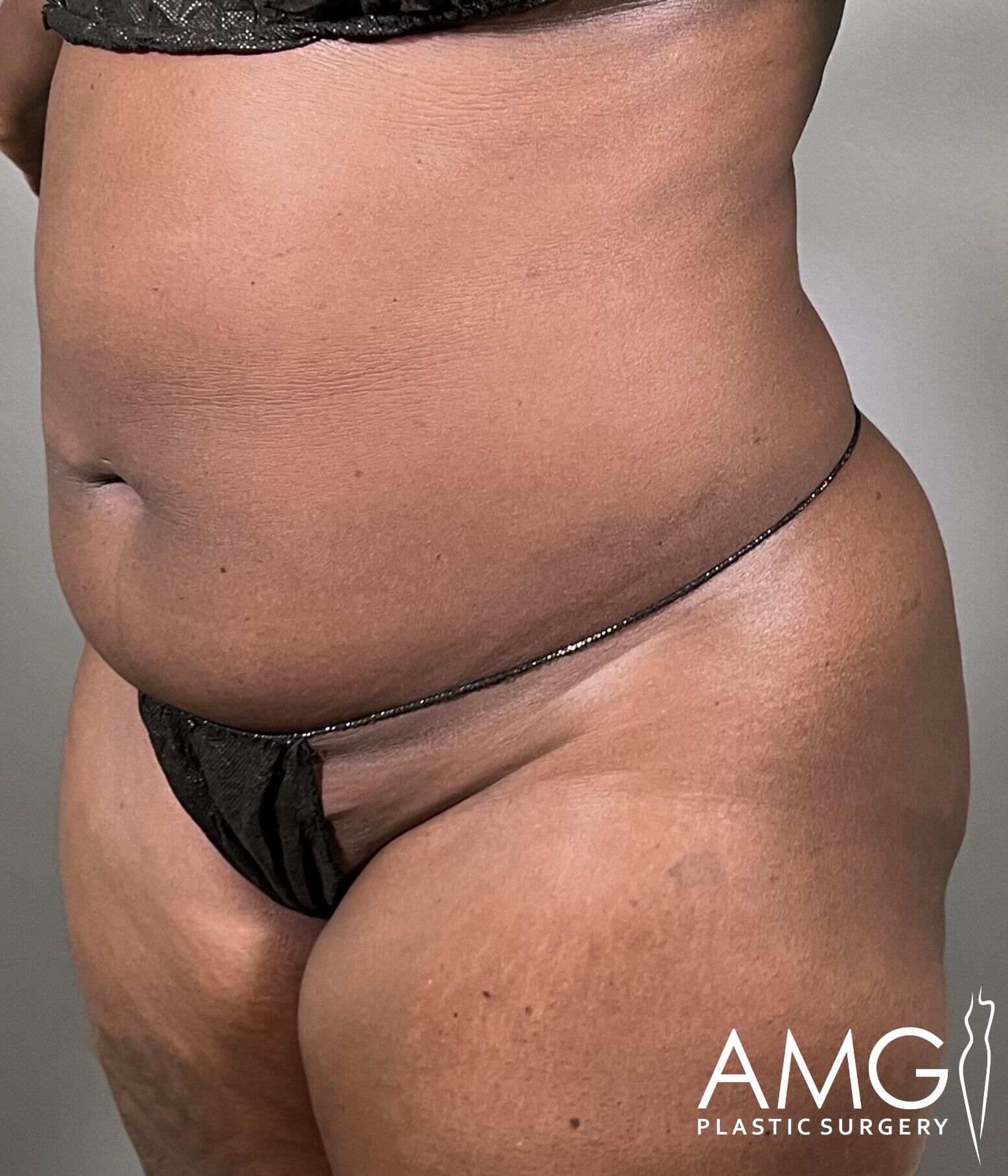 A person in black undergarments stands in a neutral pose against a gray background. The text "AMG Plastic Surgery" is visible in the corner.