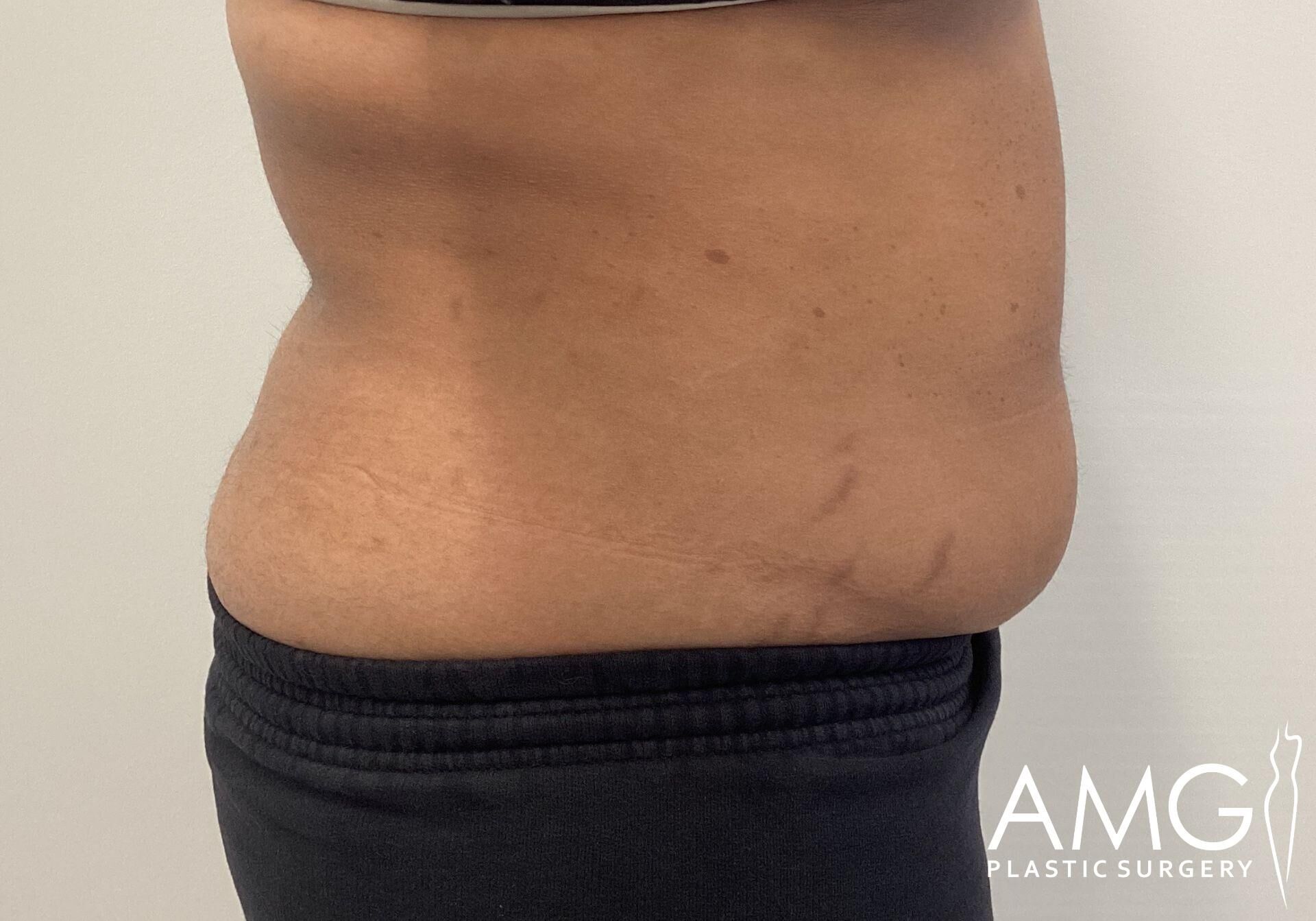 Side view of a person's midsection, showing a slight bulge and stretch marks. Black pants are worn, and the background is plain. AMG Plastic Surgery logo in the bottom right corner.