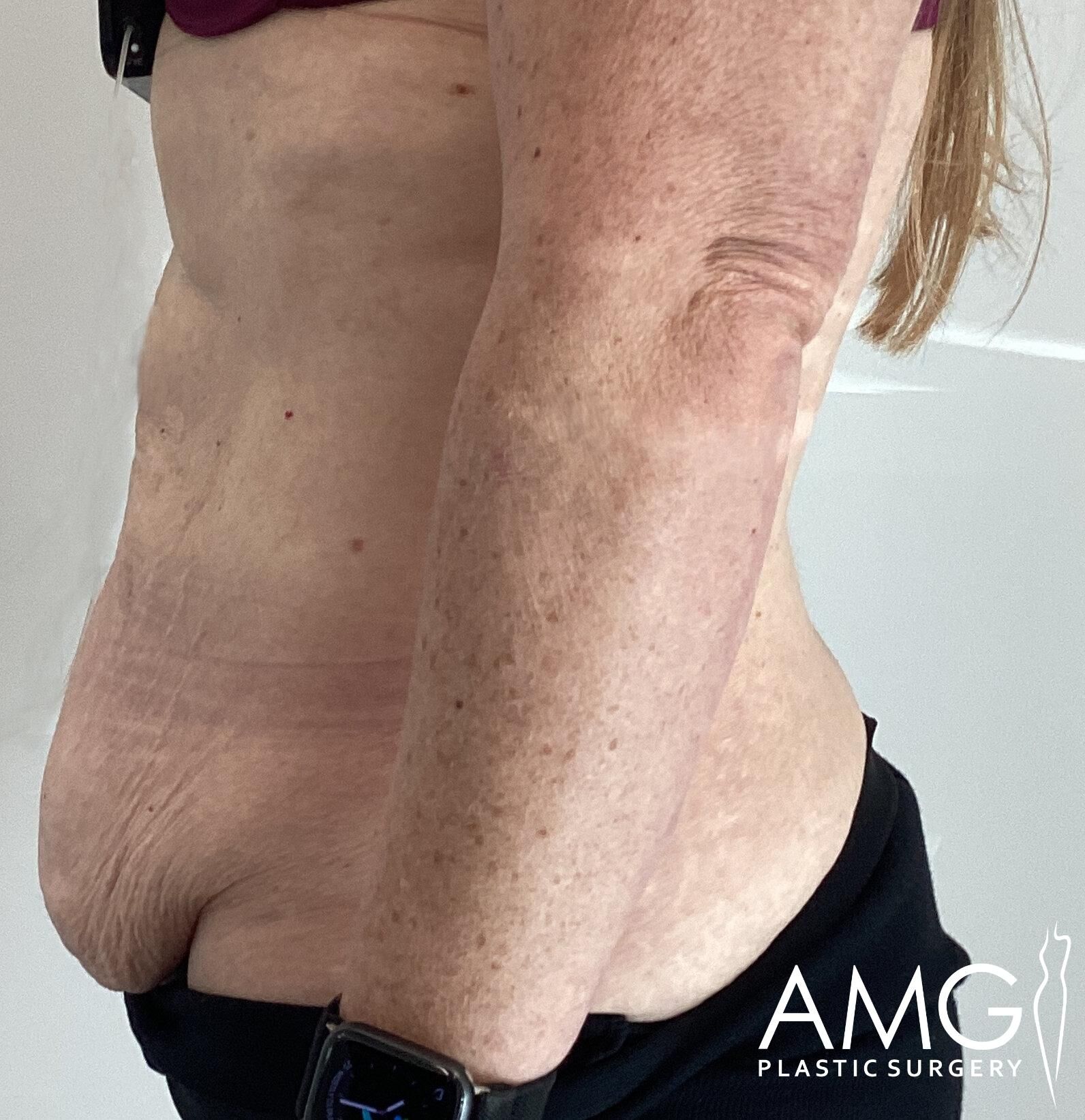 Side profile of an older person showing the torso and arm, wearing a dark top. The image is associated with AMG Plastic Surgery.