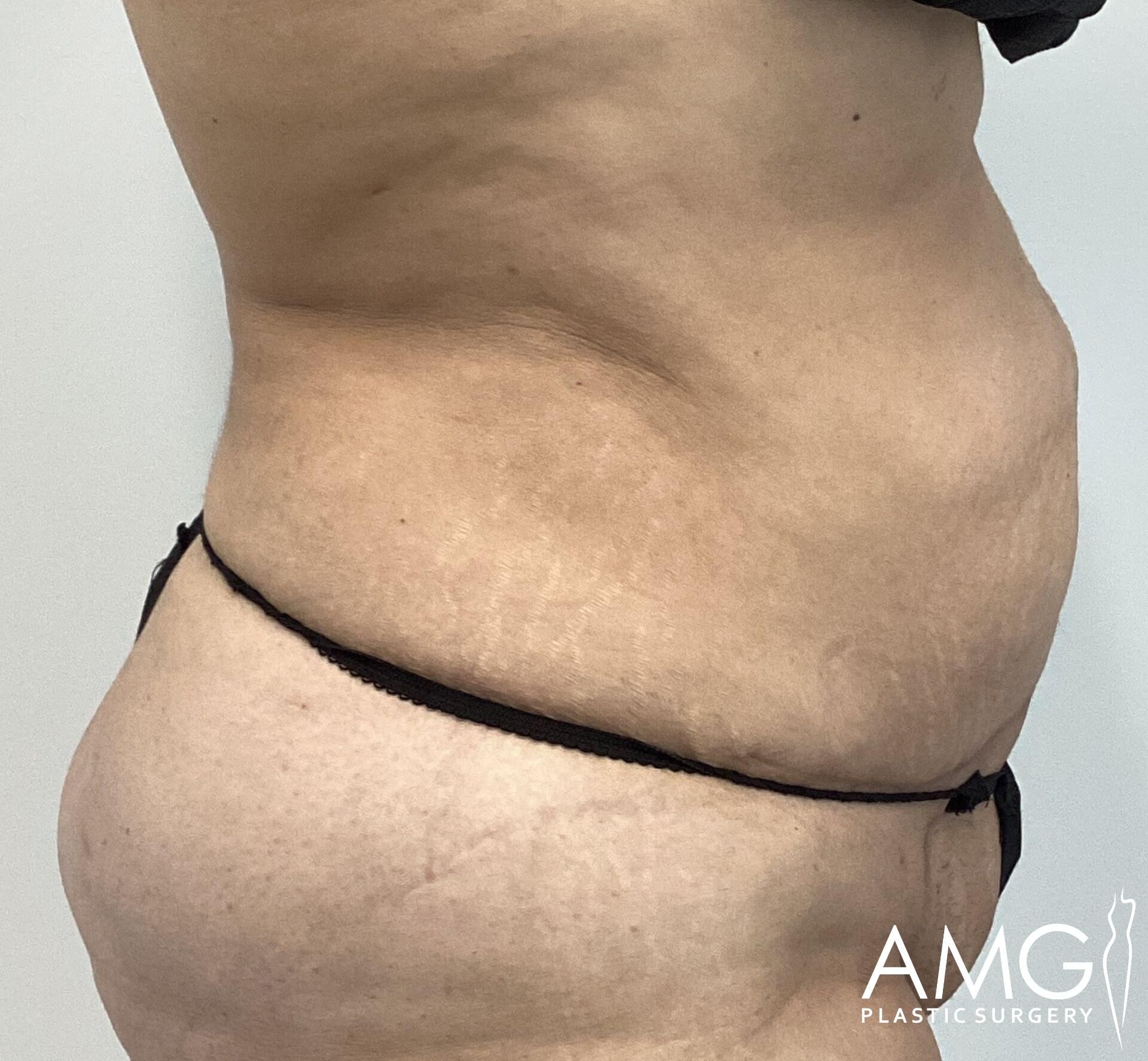 Side view of a person's abdomen with visible skin folds and stretch marks. They're wearing black underwear. The image has a logo in the corner that says "AMG Plastic Surgery.