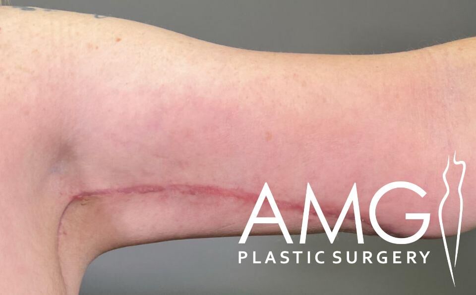 A close-up of an arm with a visible surgical scar along the inner side, displaying the AMG Plastic Surgery logo.