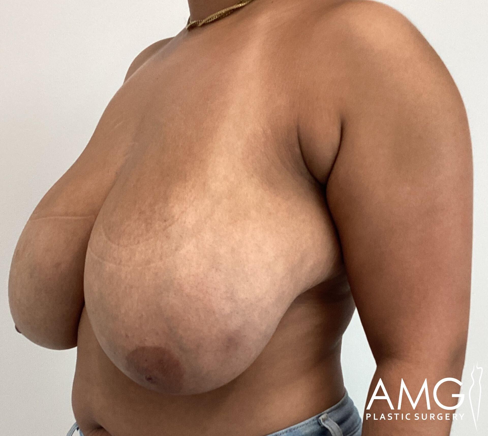 A person with visible breast ptosis and stretch marks, wearing a necklace and denim jeans. Logo of "AMG Plastic Surgery" in the bottom right corner.