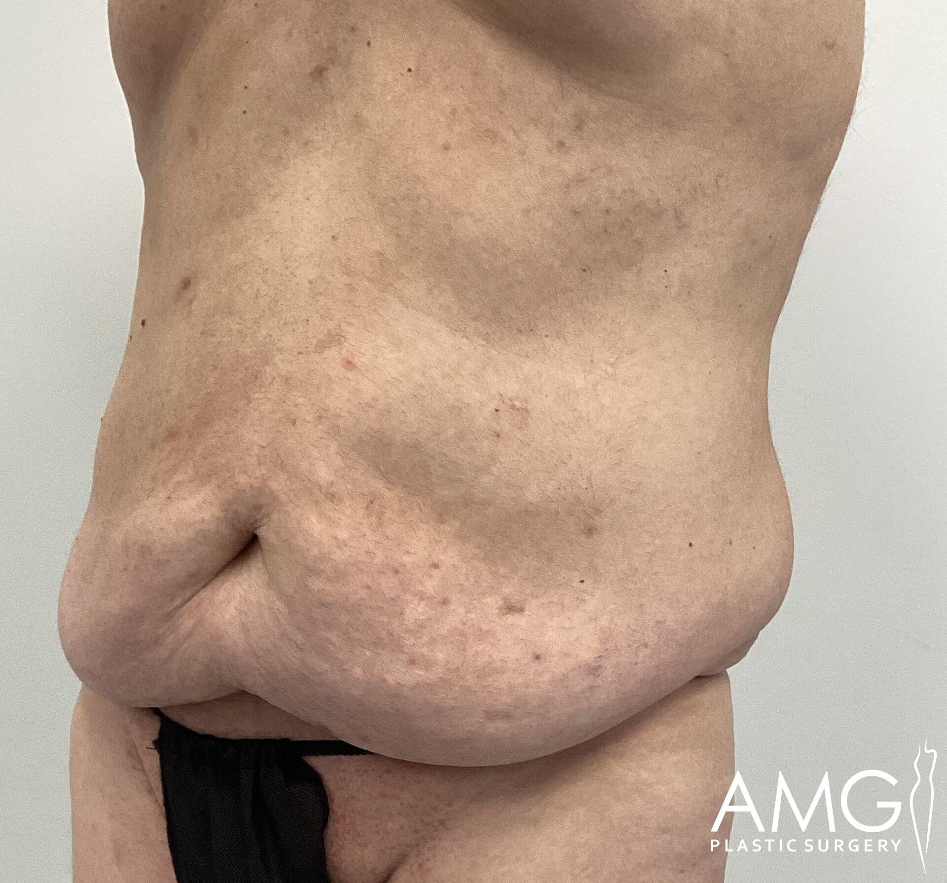 Side profile of an adult with loose, sagging abdominal skin.