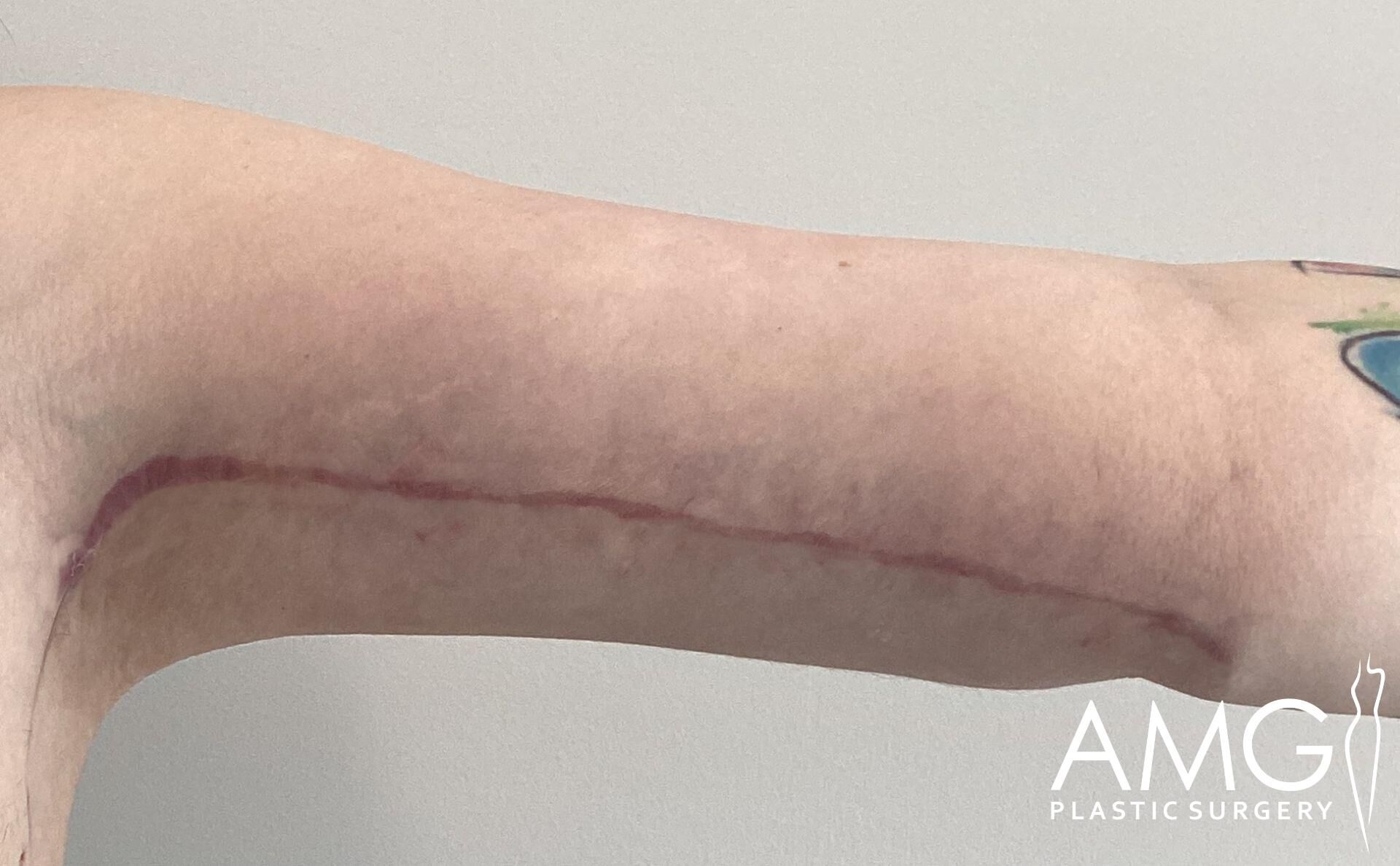 Close-up of a person's arm with a long, healed surgical scar running from the elbow to the armpit. The image has the logo "AMG Plastic Surgery" in the bottom right corner.
