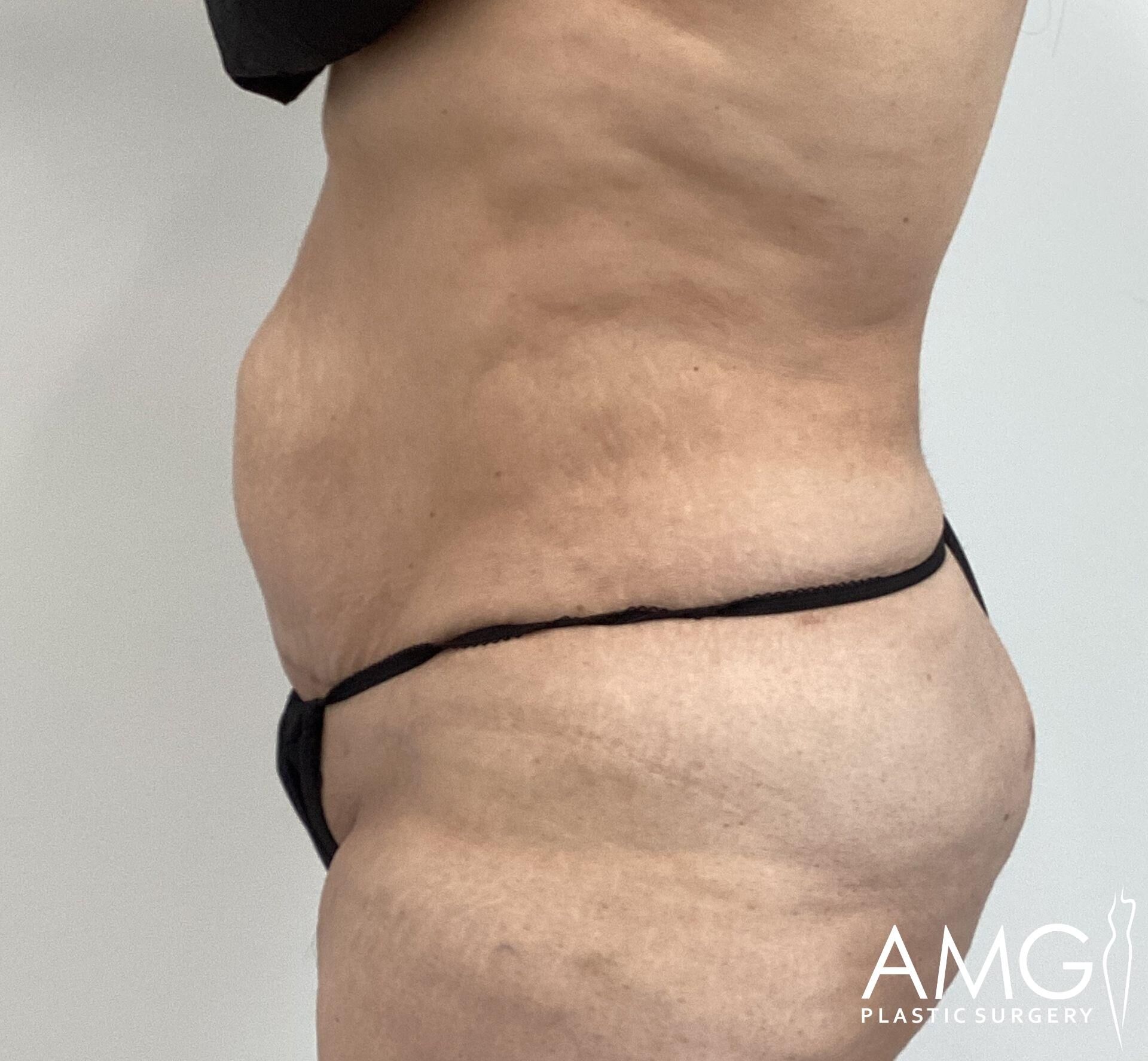 Side view of a person wearing black undergarments, displaying skin texture and natural body contours.