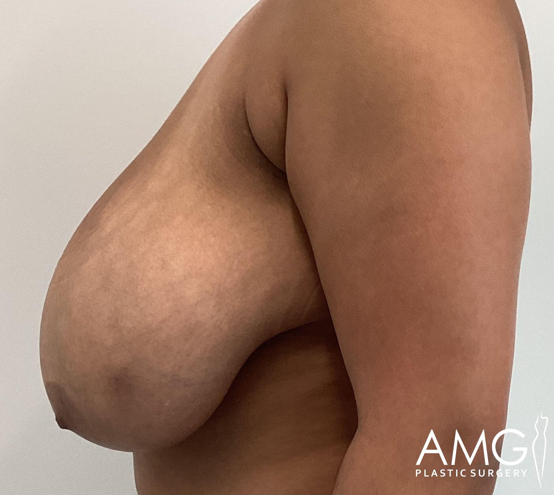 Side view of a person's upper body with noticeable breast ptosis. Logo in the bottom right corner reads "AMG Plastic Surgery.