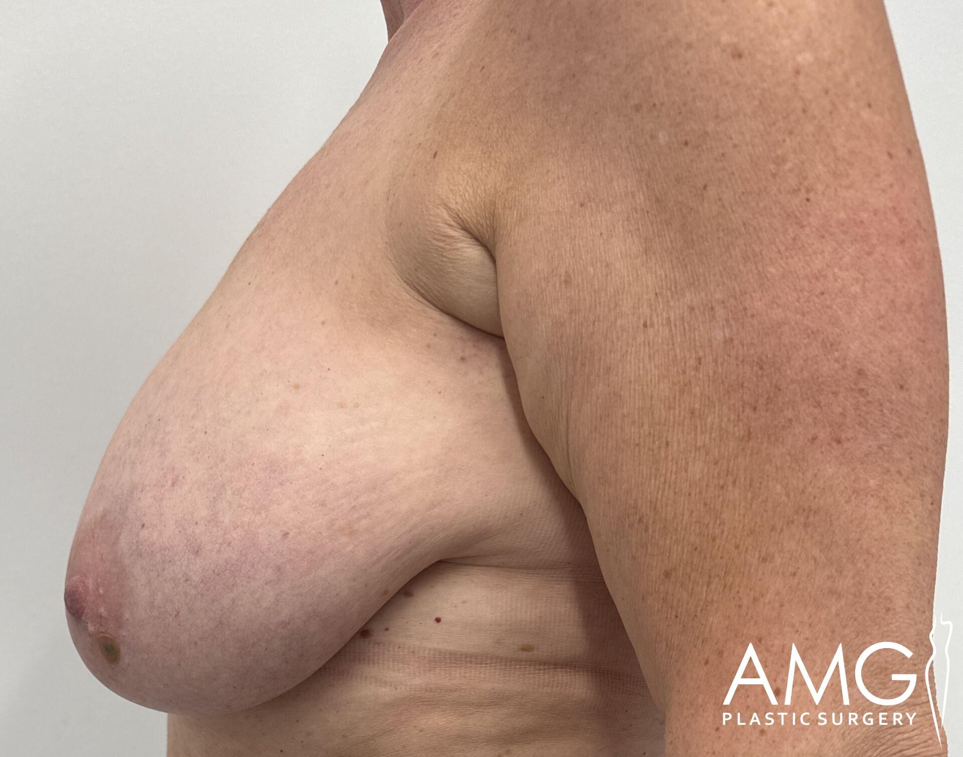 Side view of a person's upper torso with visible sagging skin and tissue. Logo: AMG Plastic Surgery.