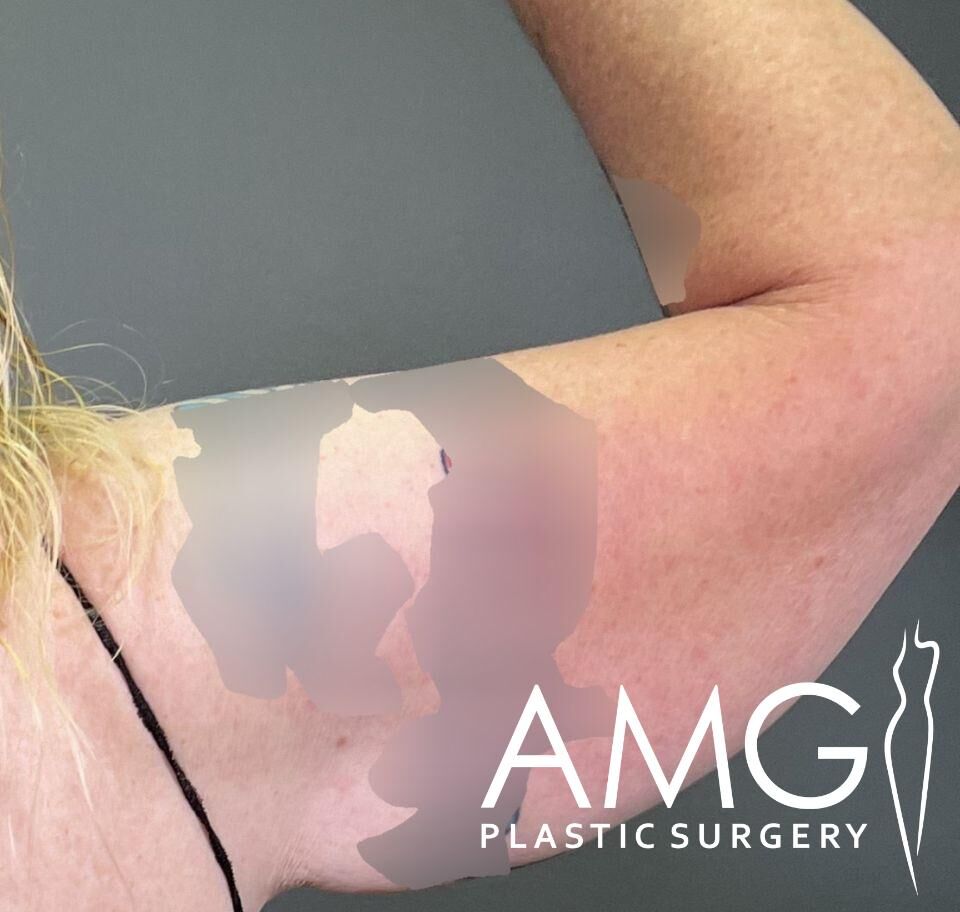 Close-up of a person's upper arm with sections highlighted and blurred, featuring the AMG Plastic Surgery logo.