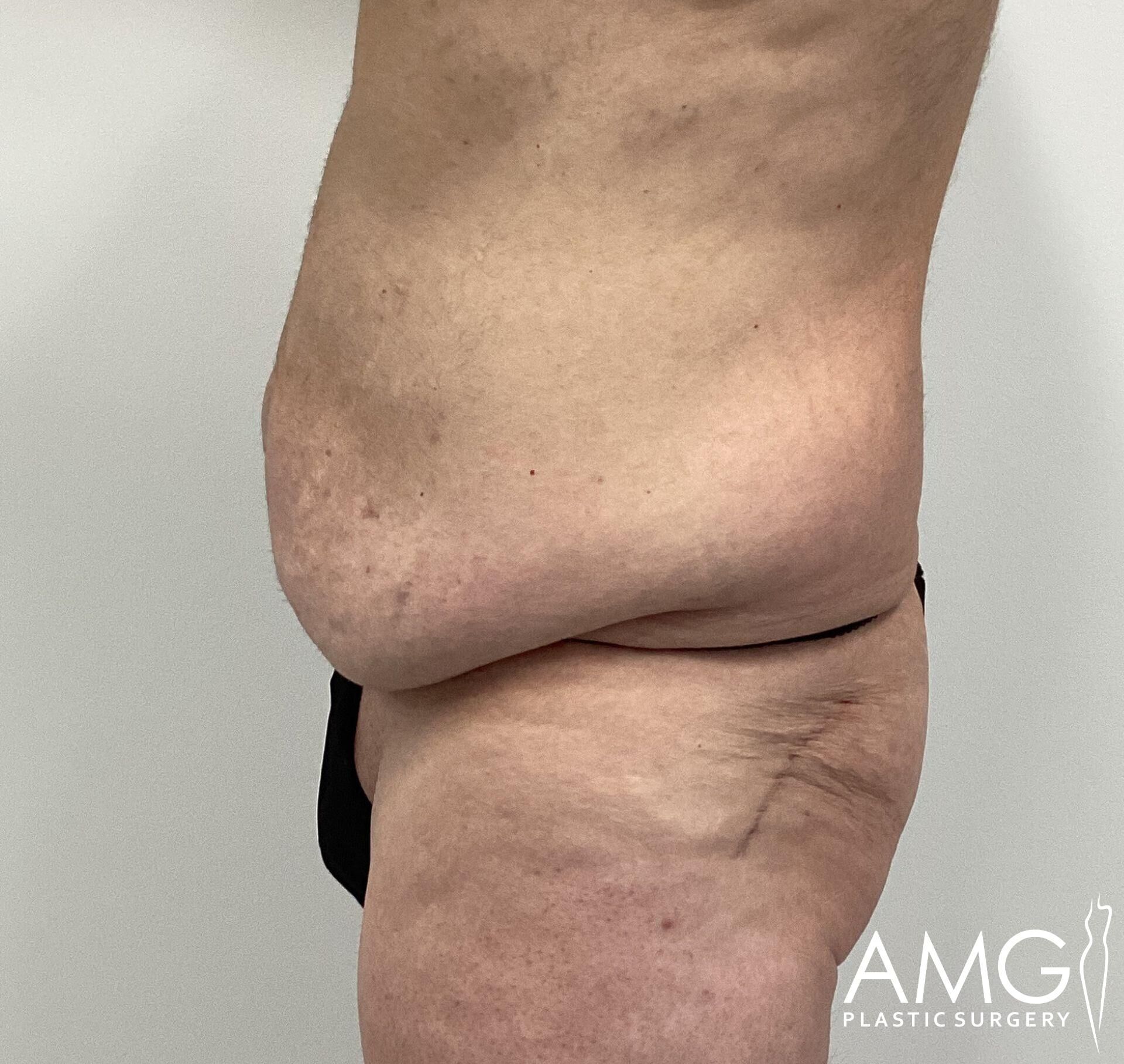 Side profile of a person's torso showing excess skin folds on the abdomen.