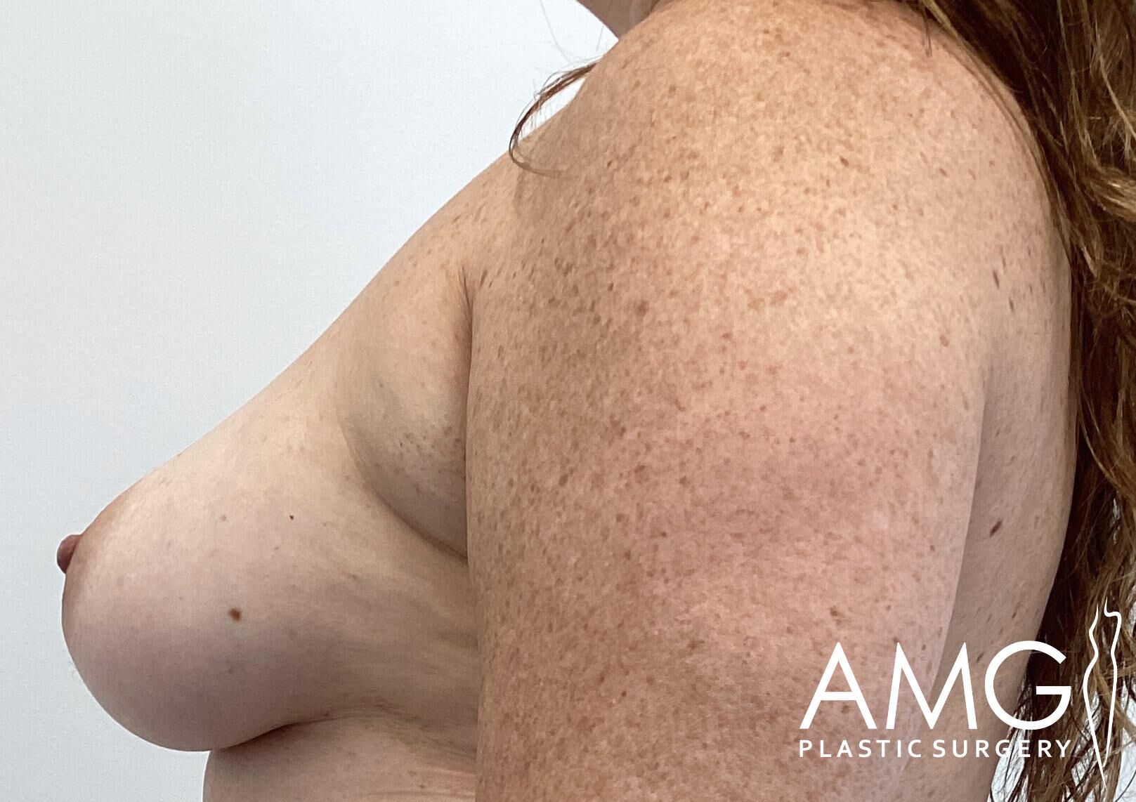 Side profile of a person's torso and arms with visible freckles and the AMG Plastic Surgery logo in the corner.