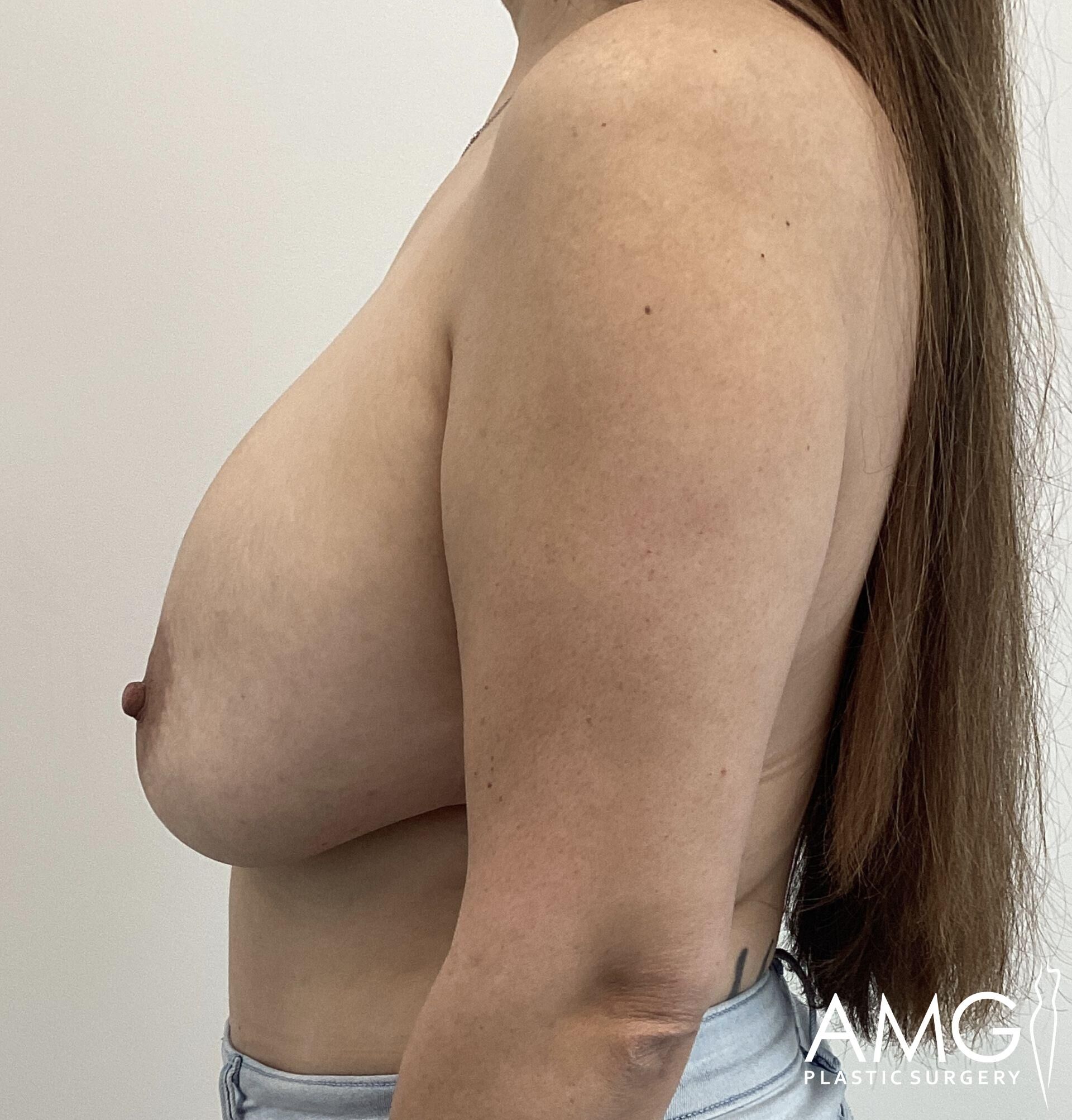 Side view of a person with long hair, exposed upper body, showing breast profile, wearing light-colored pants. Logo in the bottom right corner reads "AMC Plastic Surgery.