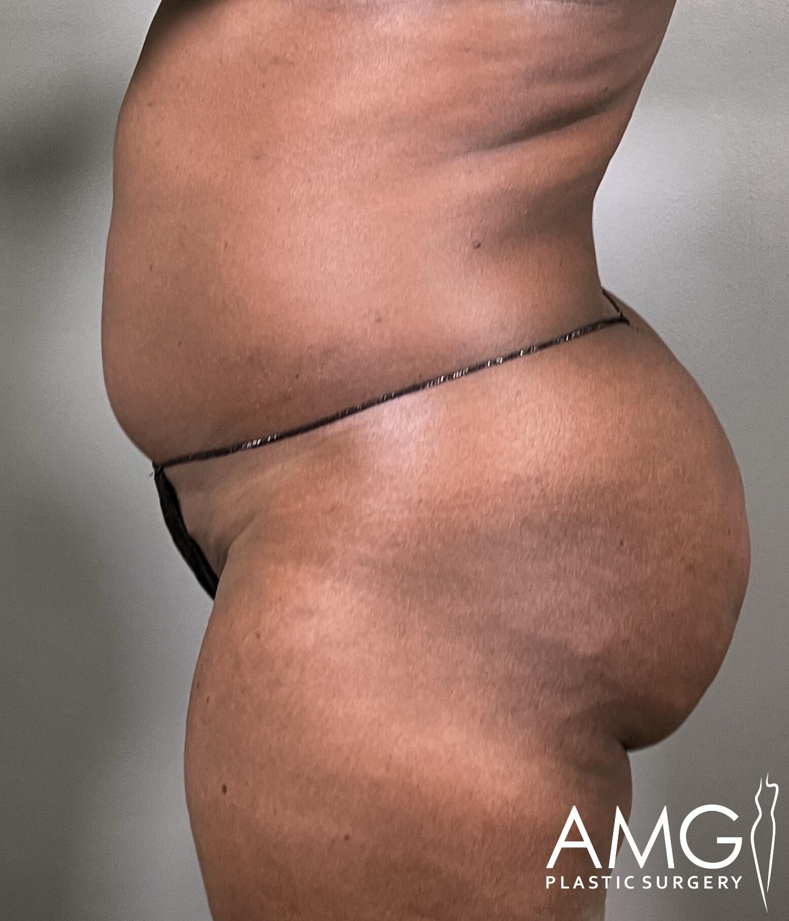 Side view of a person's torso and upper thigh showing skin texture and minimal clothing against a plain background. The AMG Plastic Surgery logo is visible in the bottom right corner.