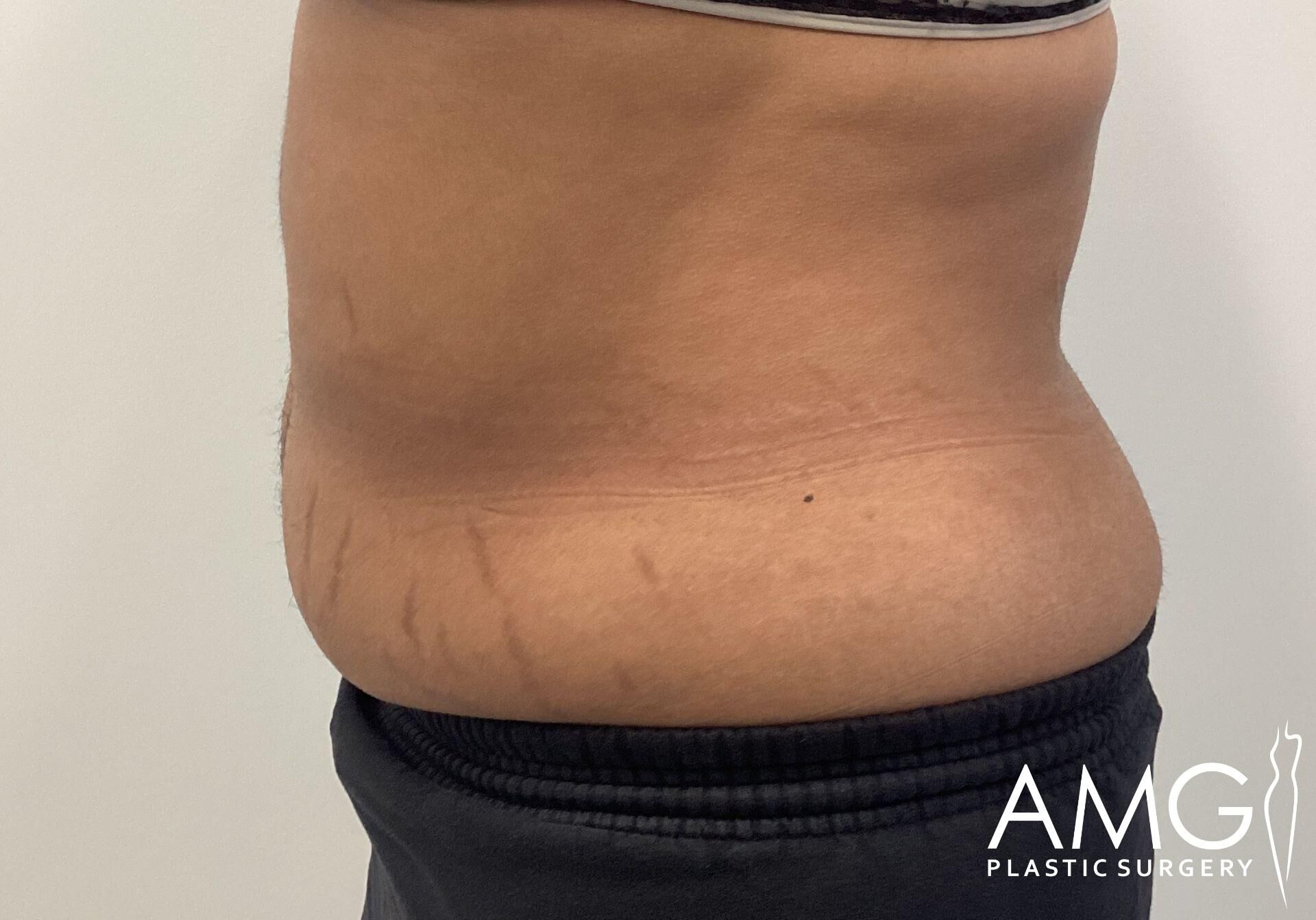 Side view of a person's midsection with visible stretch marks and excess skin. The person is wearing dark pants. "AMG Plastic Surgery" logo is visible in the bottom right corner.