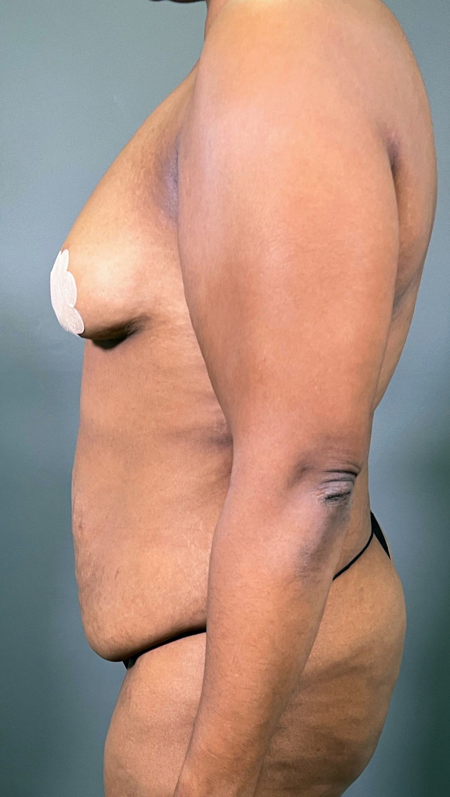 Side profile of a person with visible adhesive covers on their chest. Logo in the corner reads "AMG Plastic Surgery.