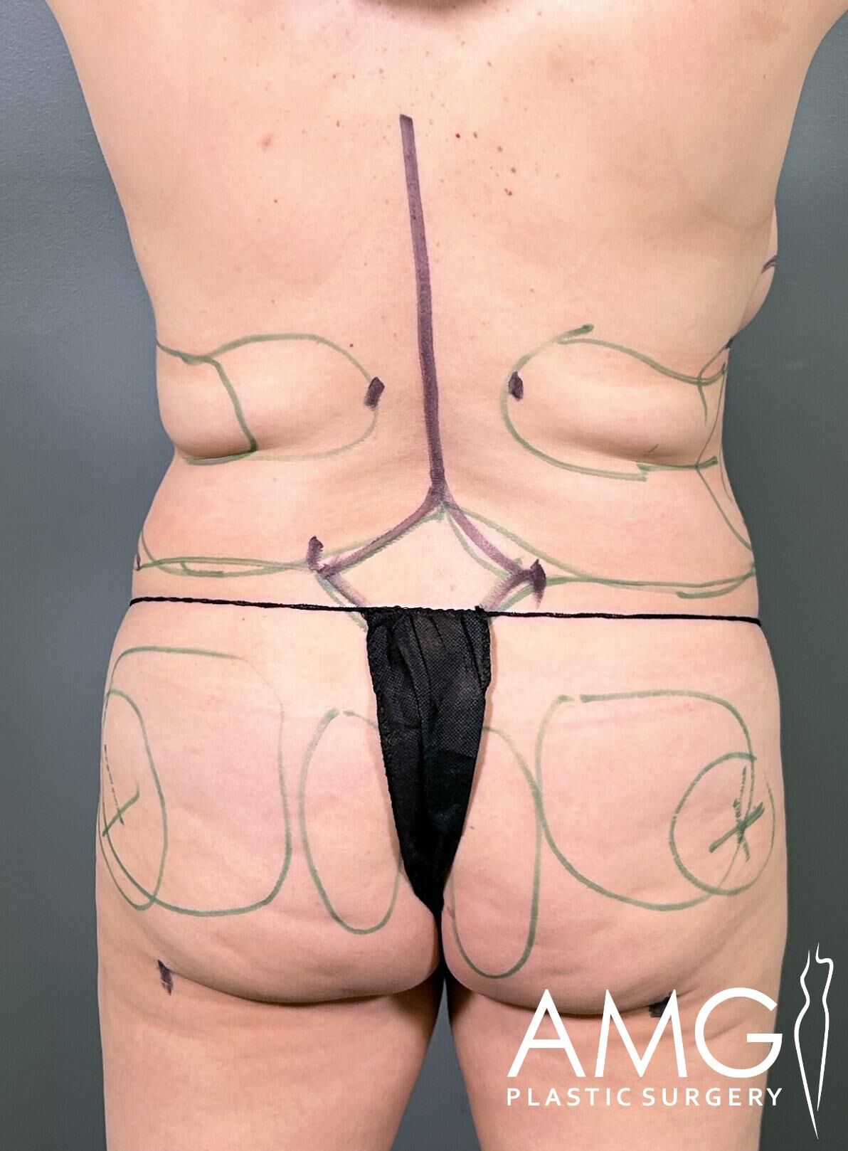A person's back with surgery markings, standing in underwear. The text "AMG Plastic Surgery" is visible.
