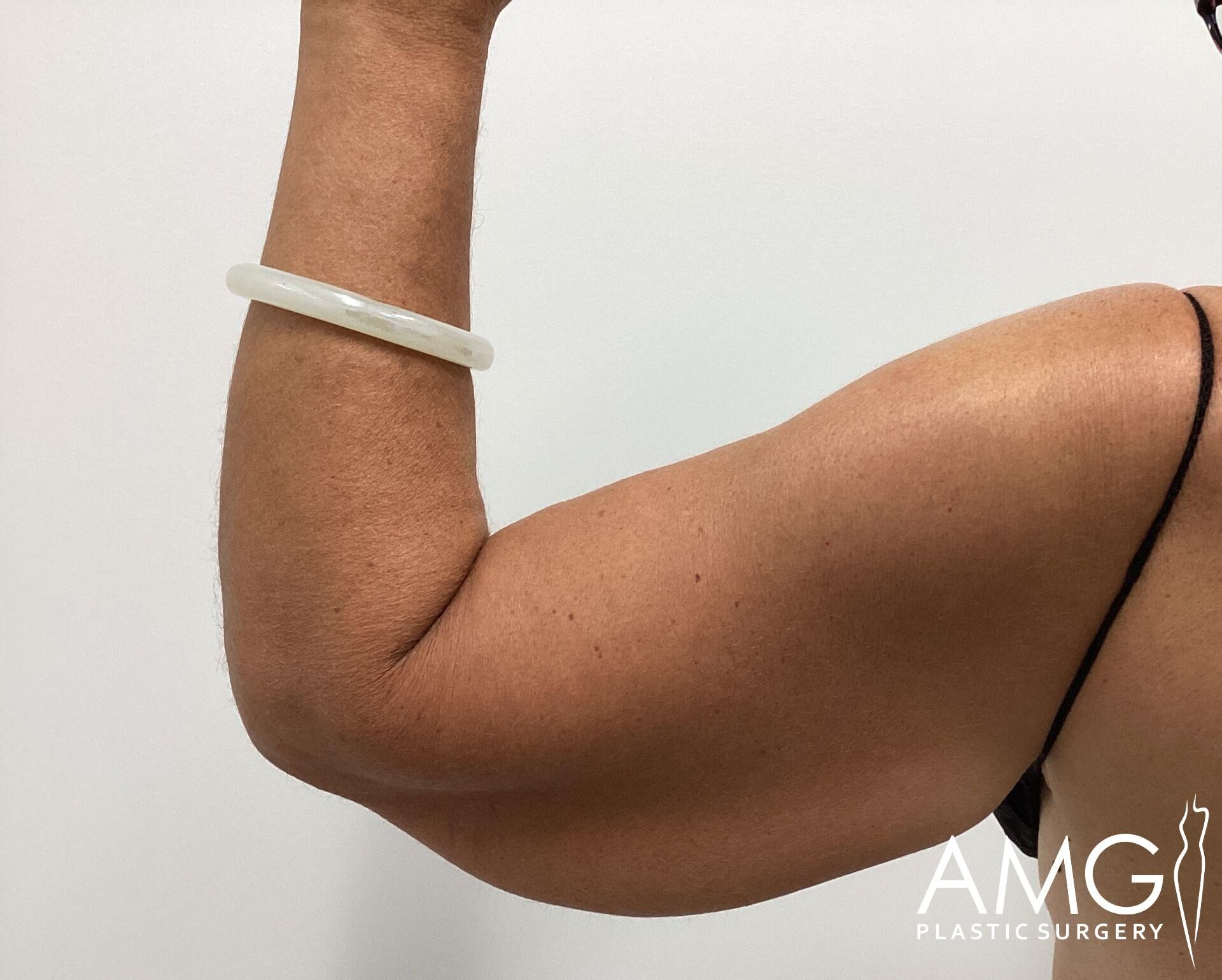 A person's arm flexing with a white bangle on the wrist, against a plain white background.