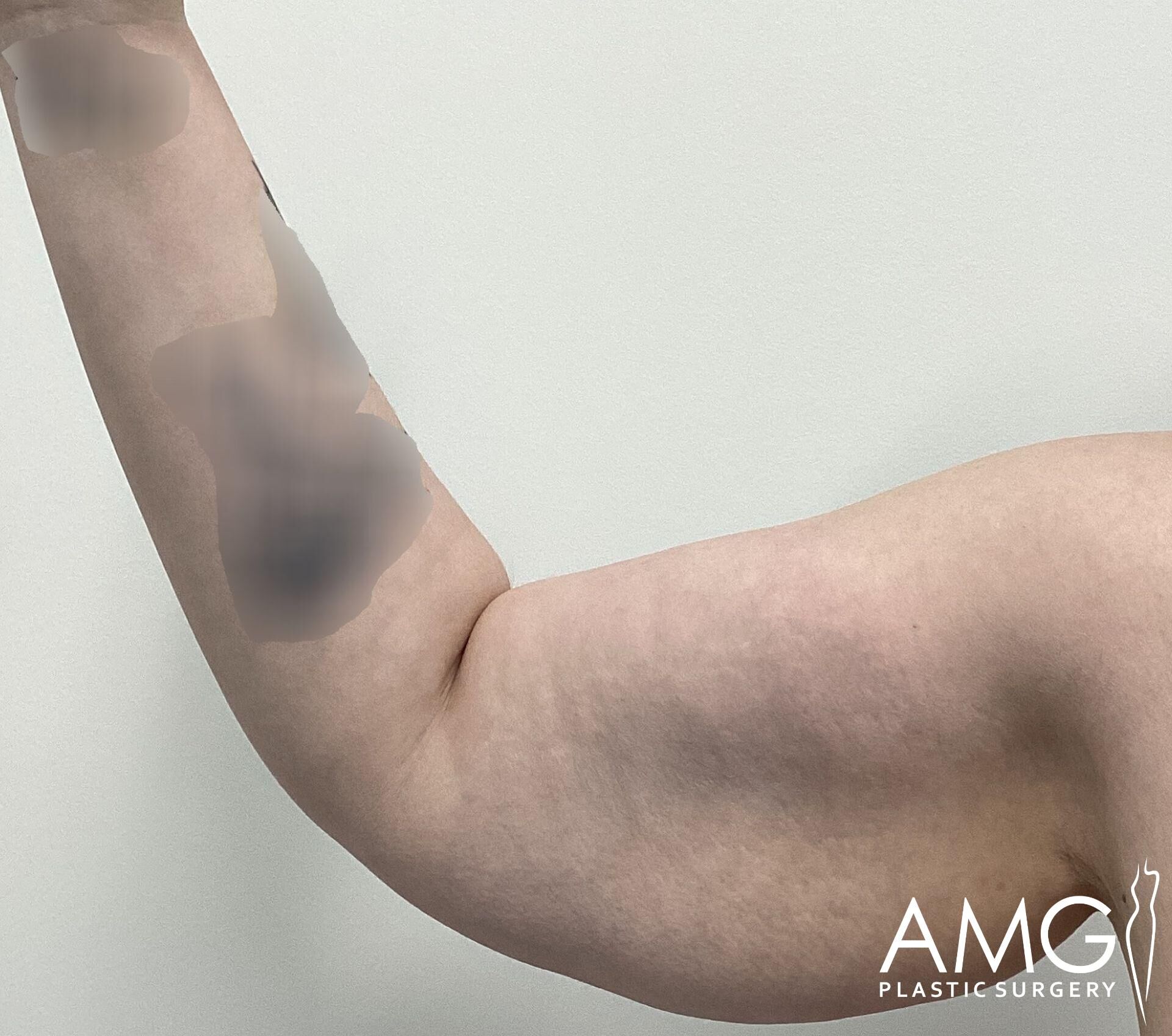A close-up of a person's arm showing excess skin on the upper arm against a plain background, with the AMG Plastic Surgery logo visible.