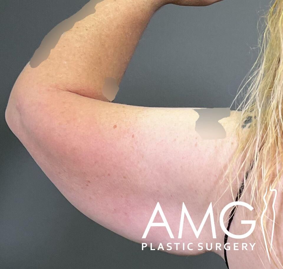 Close-up of a person's arm with visible skin texture, against a gray background. Text in the corner reads "AMG Plastic Surgery.