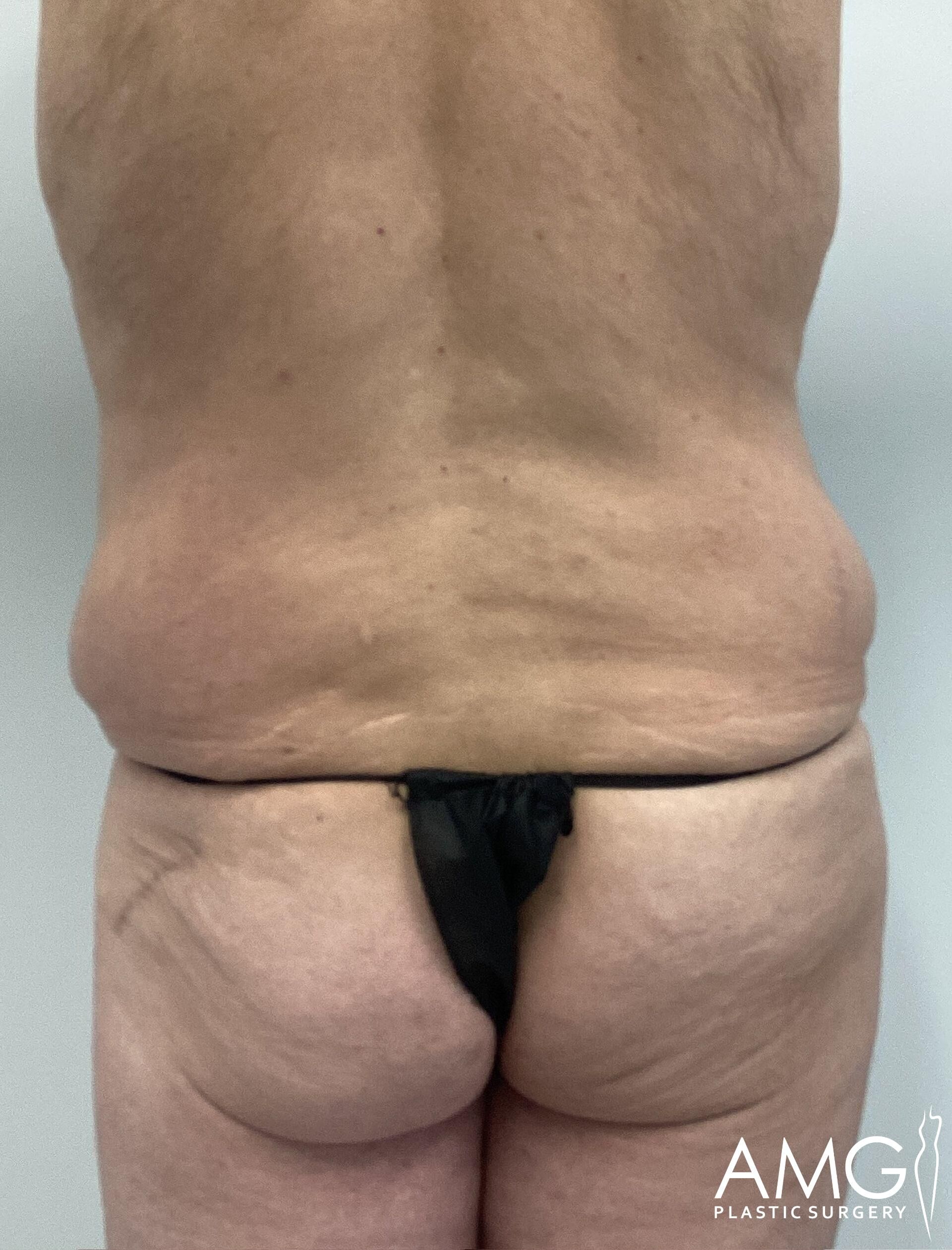 Back view of a person with excess skin around the lower back and waist, wearing minimal black clothing. Plastic surgery clinic logo visible in the corner.