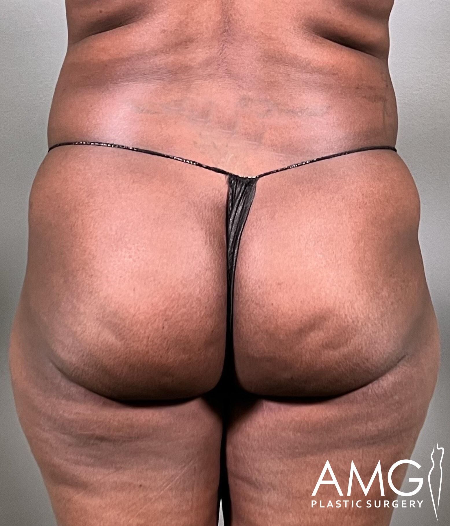 Back view of a person wearing black underwear, highlighting their lower back and buttocks. The image includes a logo for AMG Plastic Surgery in the bottom right corner.
