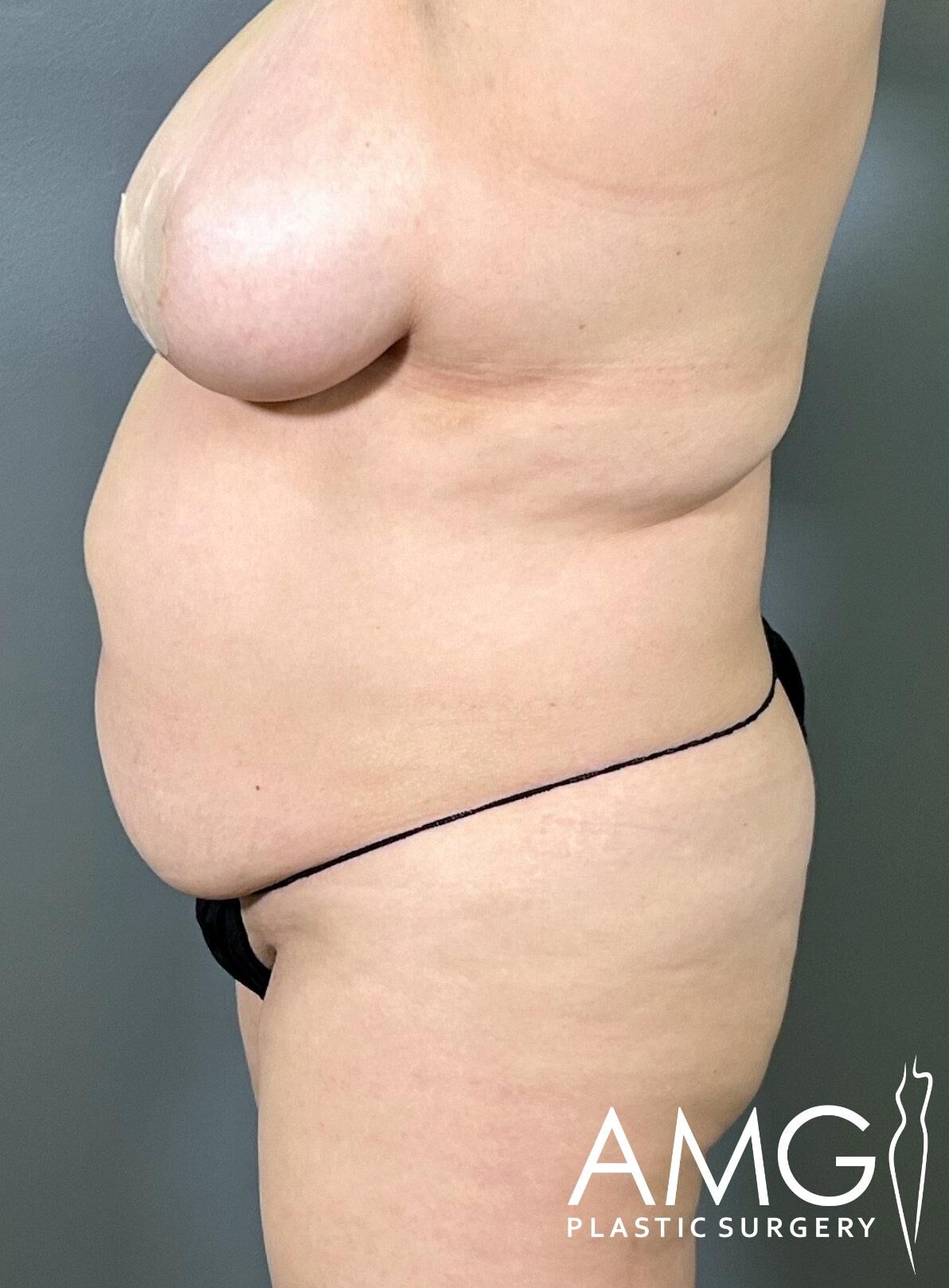Side view of a person's torso wearing a black underwear with a drawn line on the abdomen area. The person is standing against a gray background. AMG Plastic Surgery logo is in the corner.