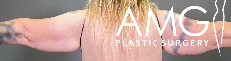 Person with blonde hair and tattoos on their arms, wearing a black strap top, with the words "AMG Plastic Surgery" overlaid on the image.