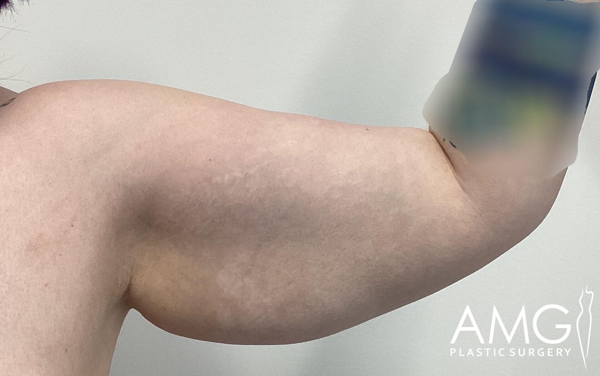 A close-up of an arm showing muscle definition. The skin appears smooth with a slight texture underneath. The background is plain white, and an area near the elbow is blurred.