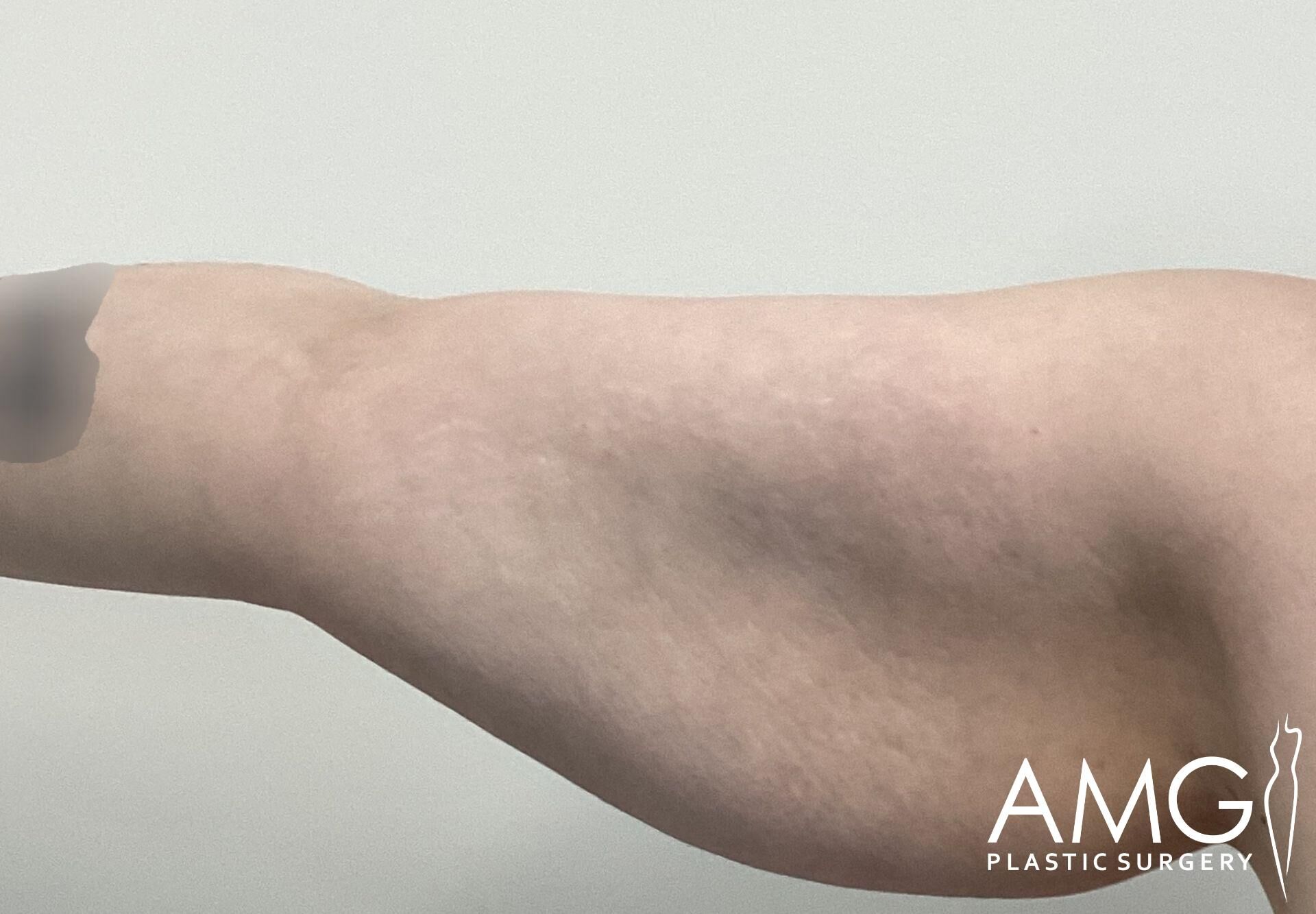 A human arm showing loose skin, with the AMG Plastic Surgery logo in the bottom right corner.