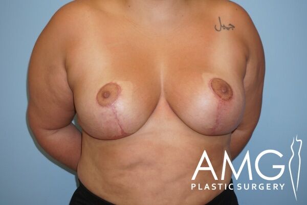 A woman with visible post-surgical scars on her breasts stands against a light blue background. The image includes the AMG Plastic Surgery logo in the lower right corner.
